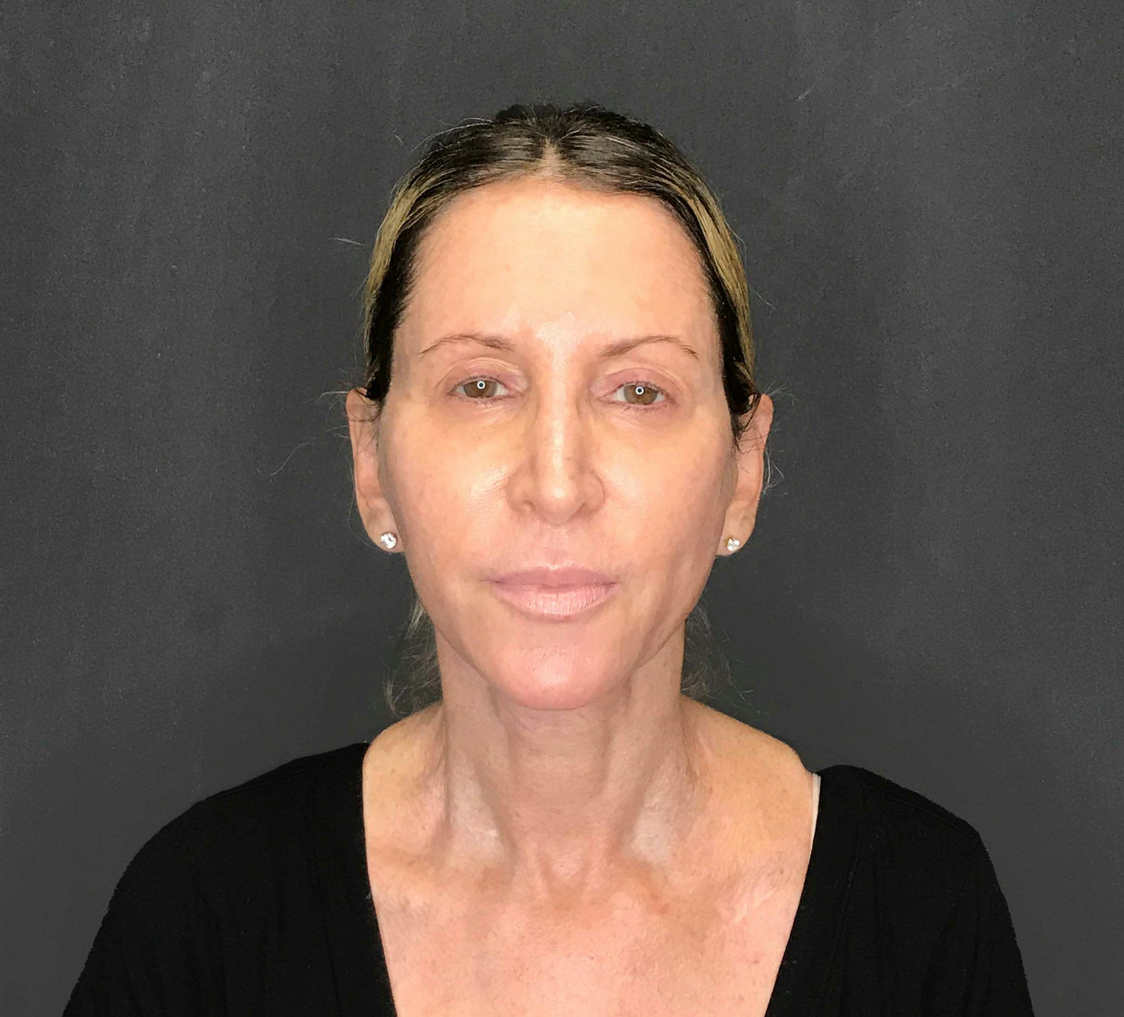 Facelift & Necklift after in NYC front view p#1