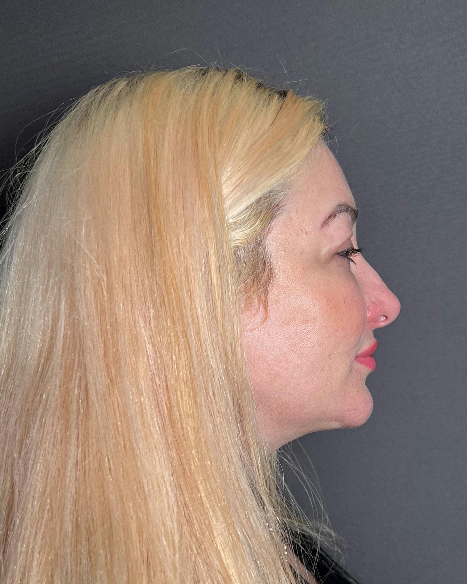 Rhinoplasty Before & After Gallery - Patient 183063818 - Image 1