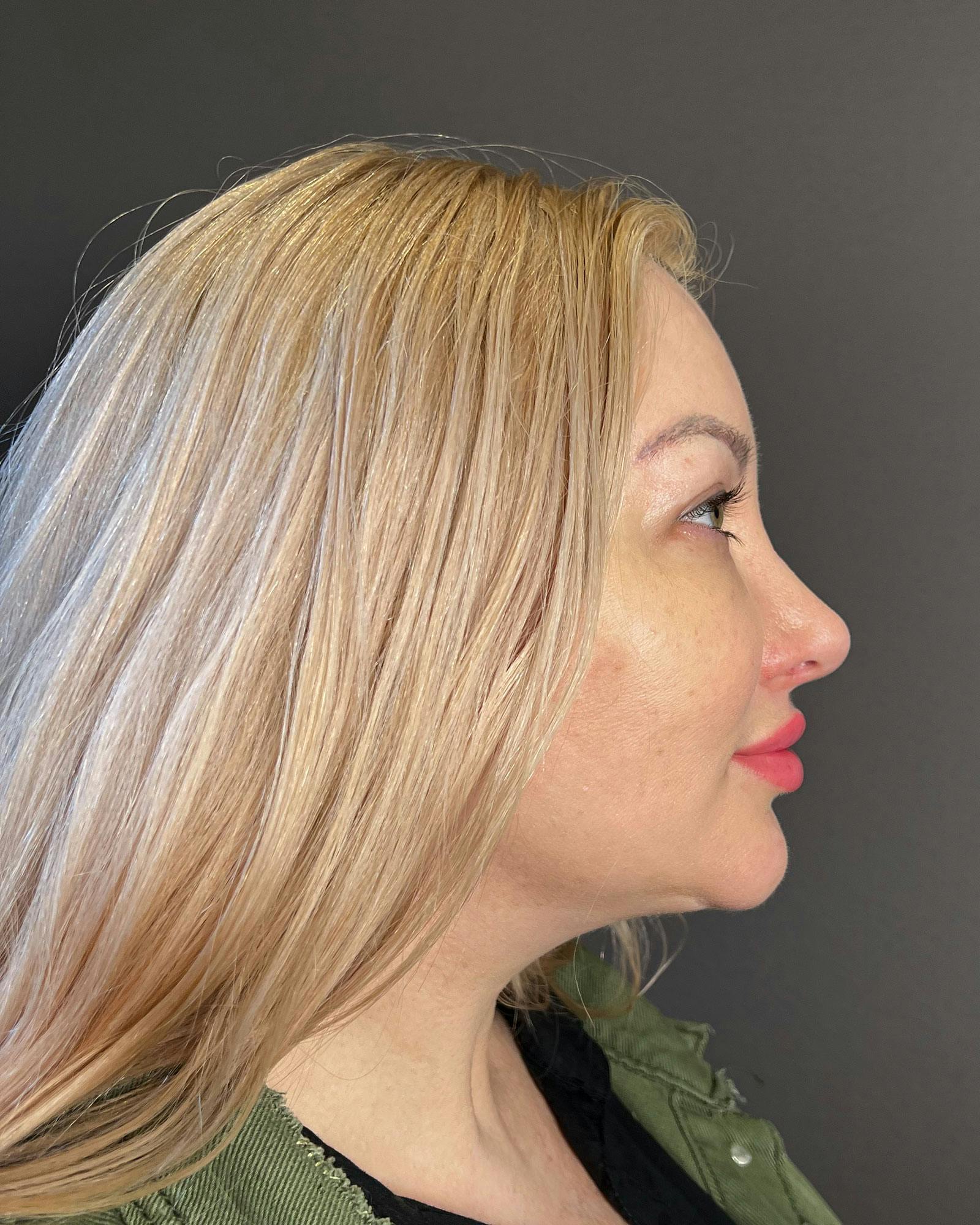 Rhinoplasty Before & After Gallery - Patient 183063818 - Image 2