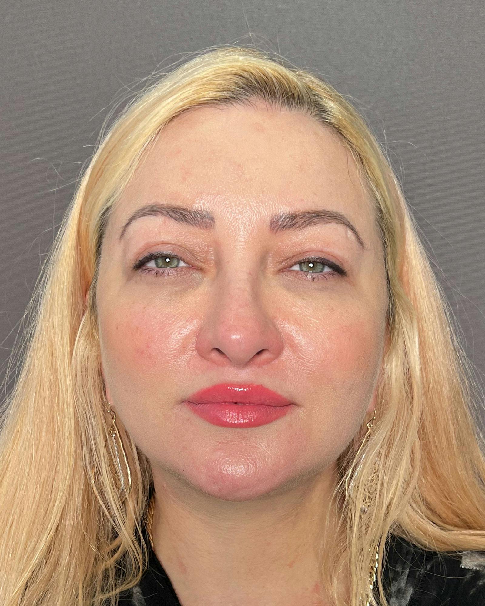 Rhinoplasty Before & After Gallery - Patient 183063818 - Image 3