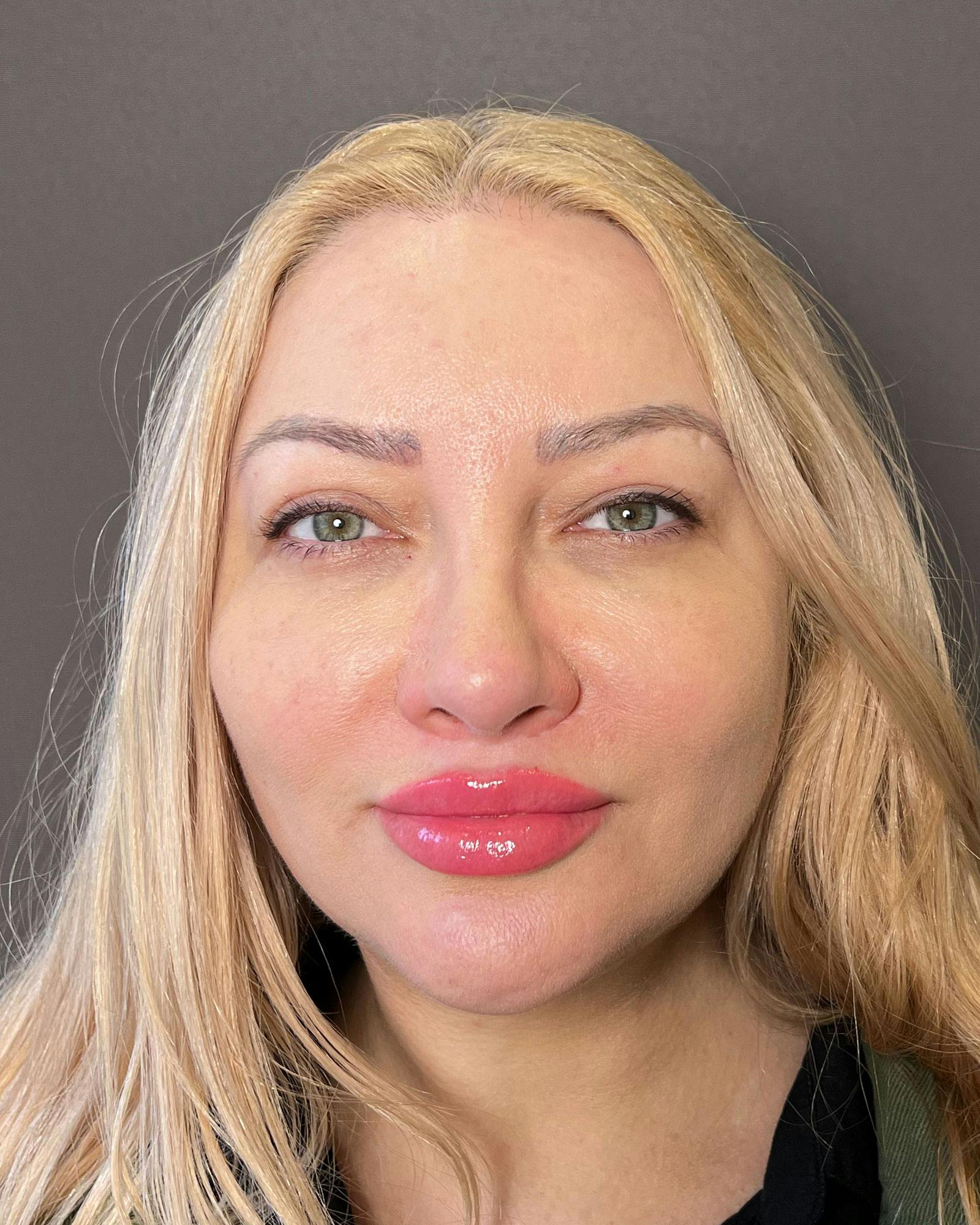Rhinoplasty Before & After Gallery - Patient 183063818 - Image 4