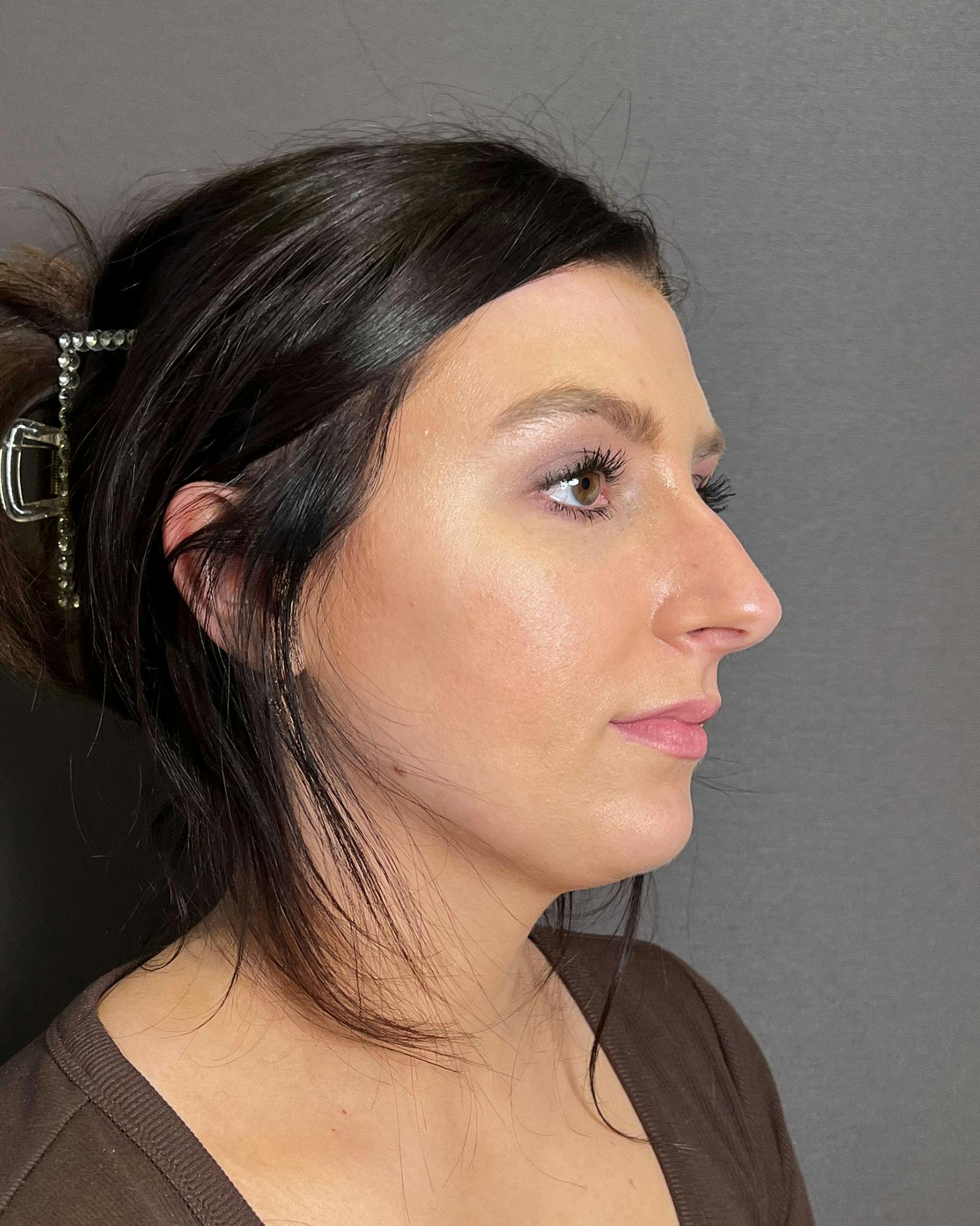 Rhinoplasty Before & After Gallery - Patient 183063819 - Image 1