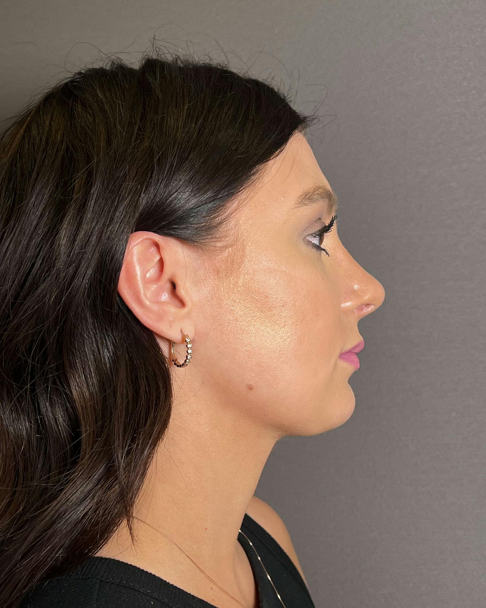 Rhinoplasty Before & After Gallery - Patient 183063819 - Image 2