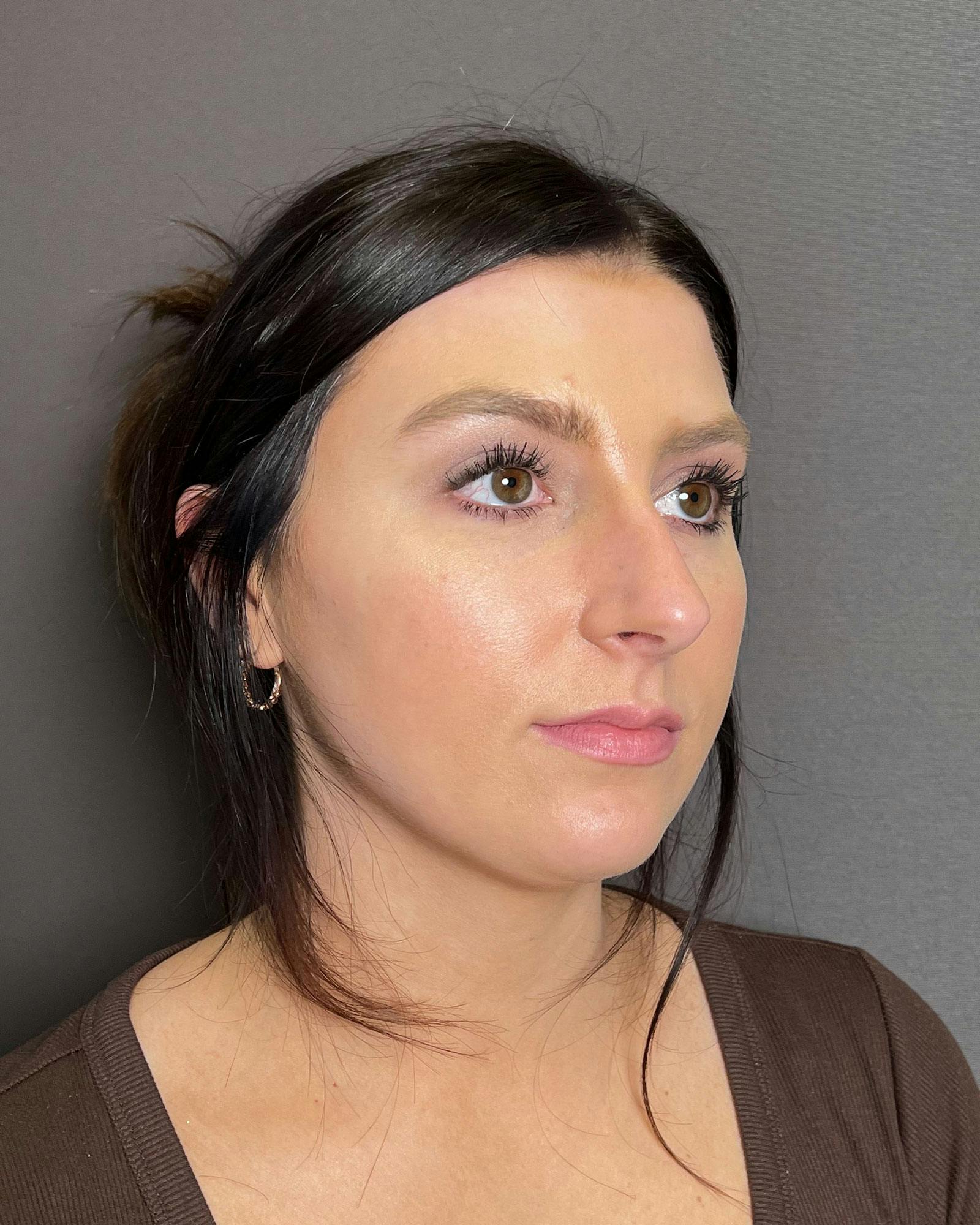 Rhinoplasty Before & After Gallery - Patient 183063819 - Image 3