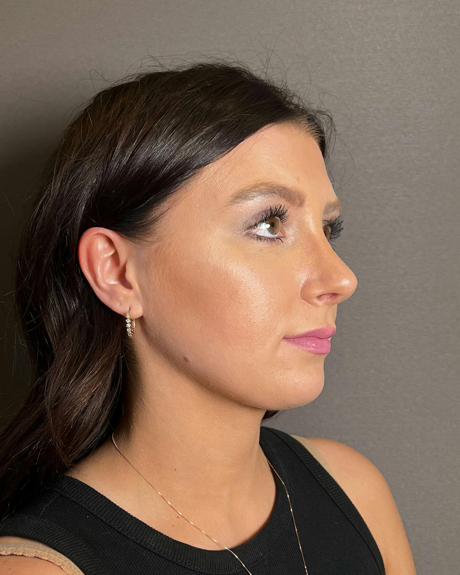 Rhinoplasty Before & After Gallery - Patient 183063819 - Image 4