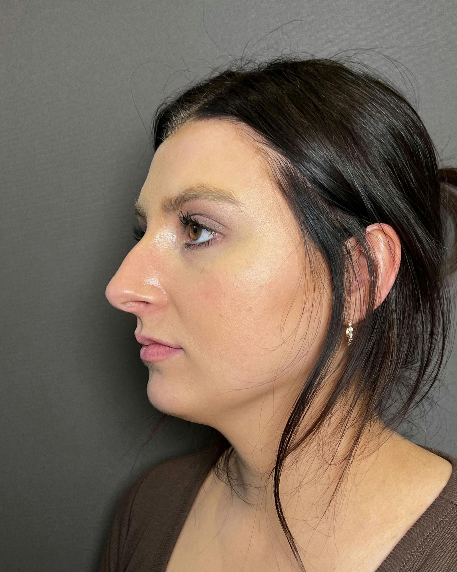 Rhinoplasty Before & After Gallery - Patient 183063819 - Image 5