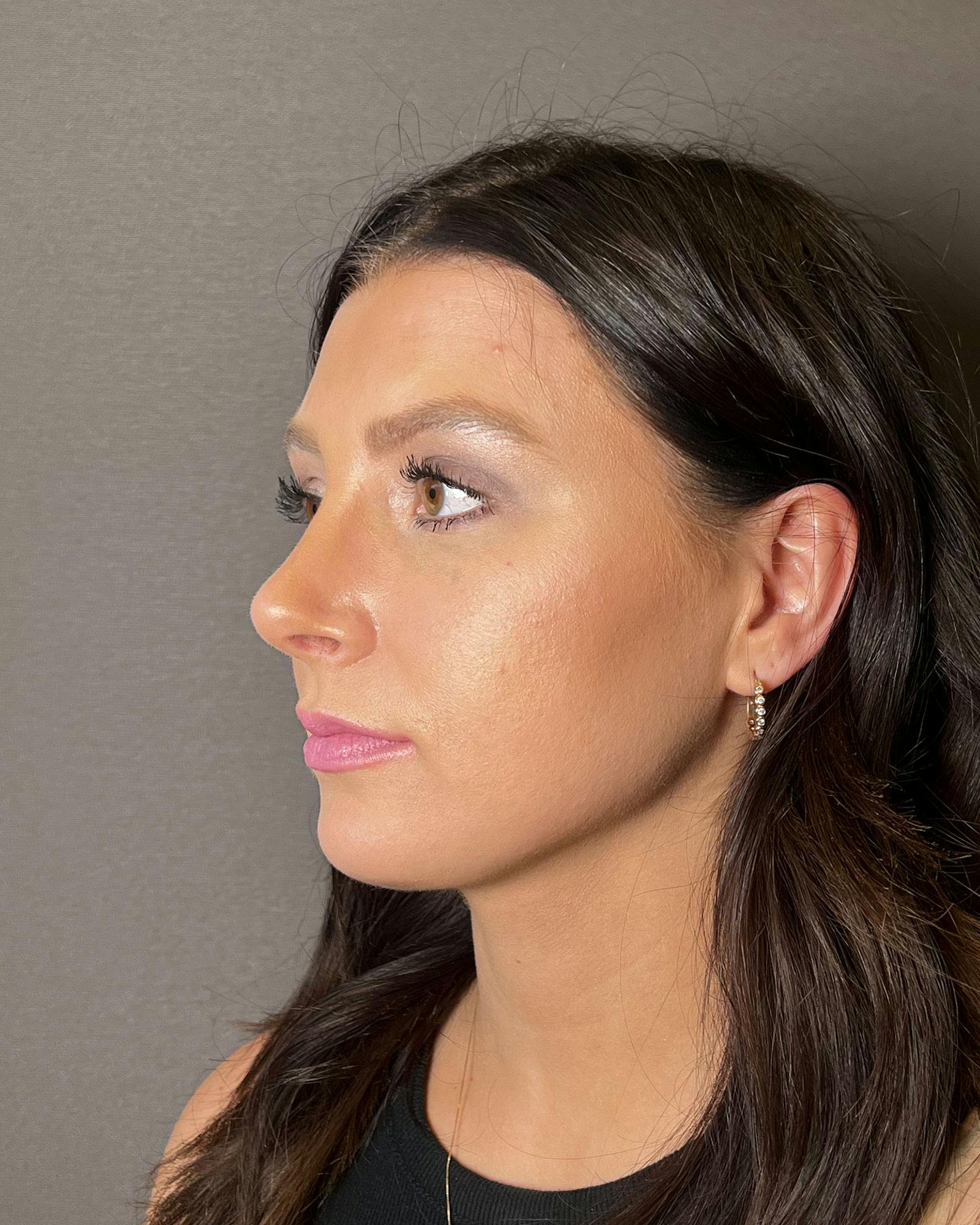 Rhinoplasty Before & After Gallery - Patient 183063819 - Image 6