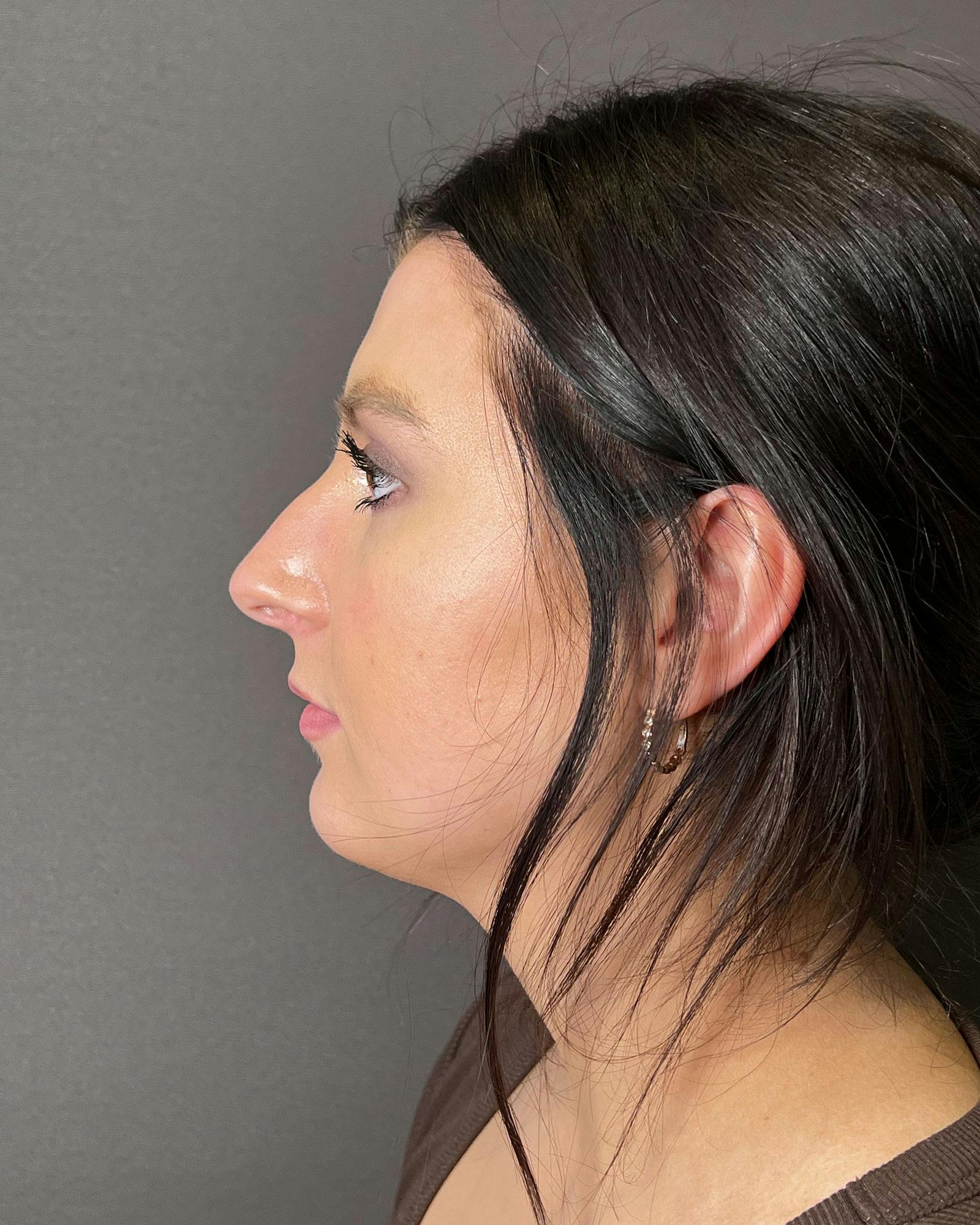 Rhinoplasty Before & After Gallery - Patient 183063819 - Image 7
