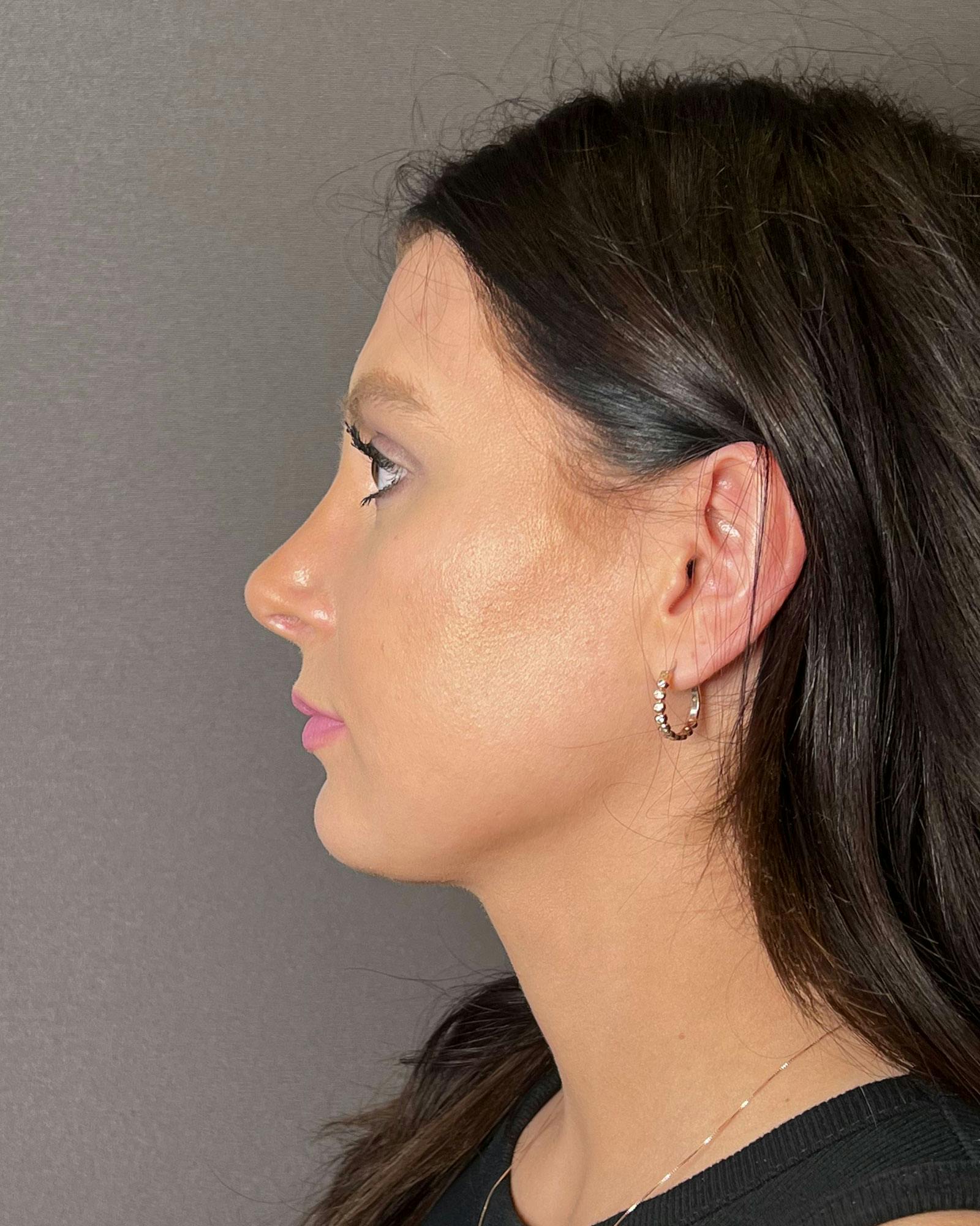 Rhinoplasty Before & After Gallery - Patient 183063819 - Image 8