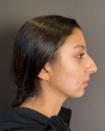 Rhinoplasty Before & After Gallery - Patient 183063820 - Image 1