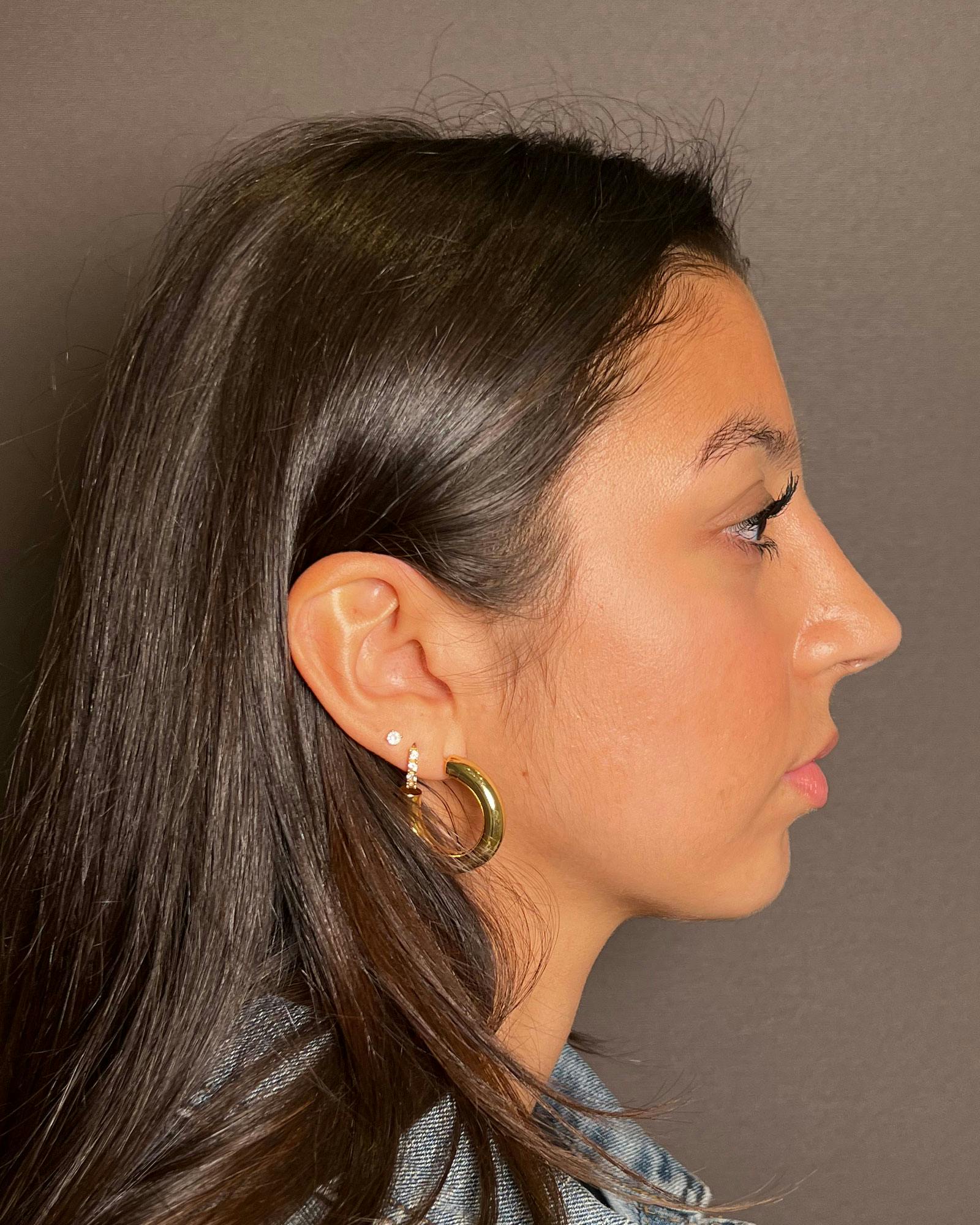 Rhinoplasty Before & After Gallery - Patient 183063820 - Image 2