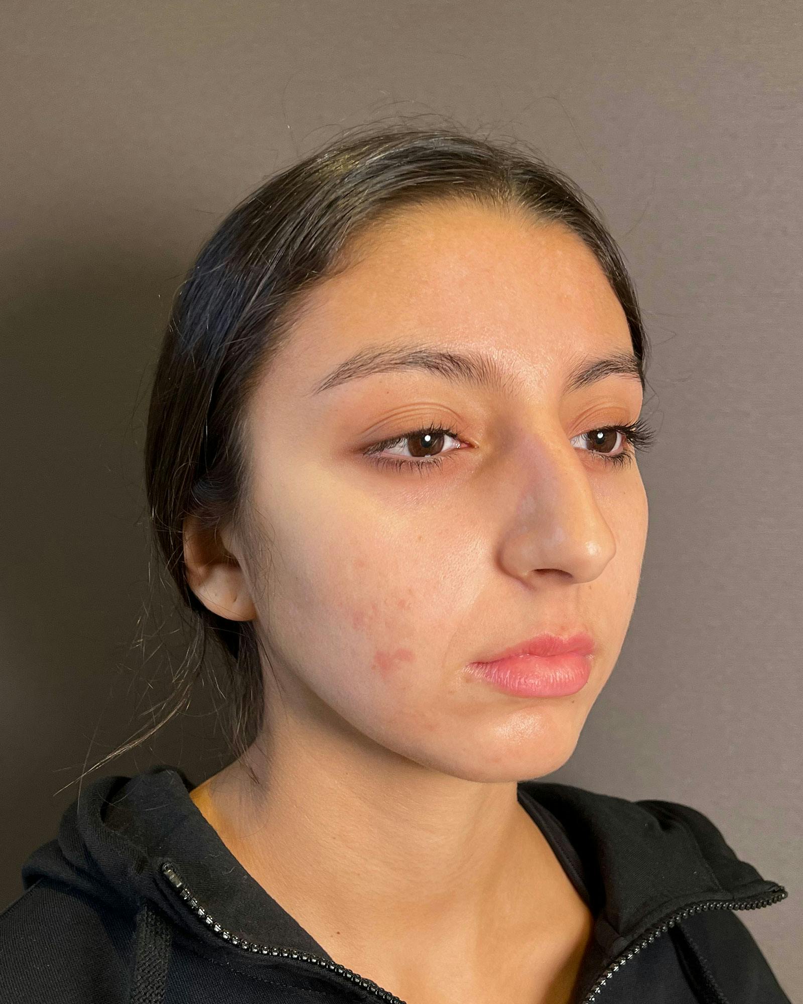 Rhinoplasty Before & After Gallery - Patient 183063820 - Image 3
