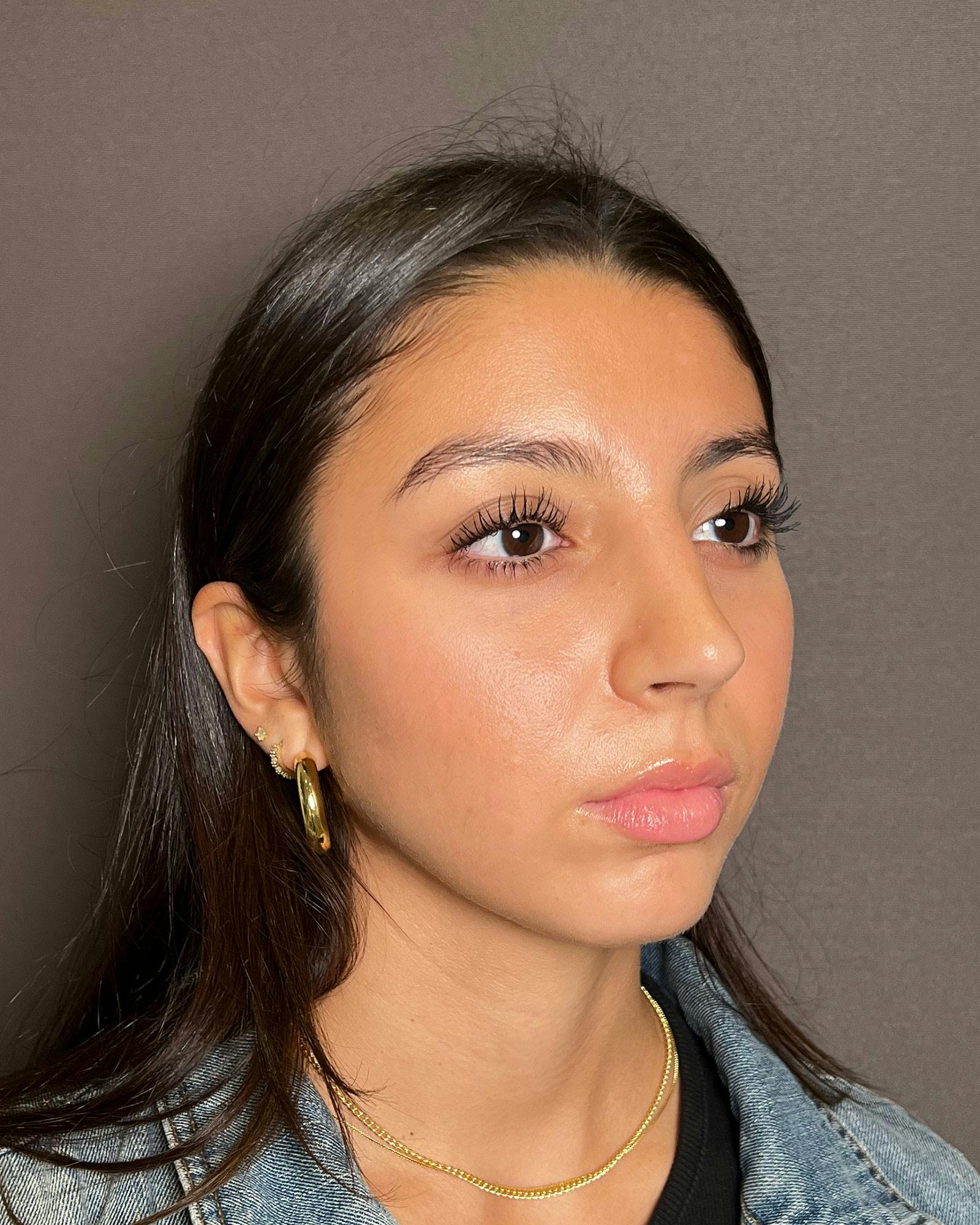 Rhinoplasty Before & After Gallery - Patient 183063820 - Image 4