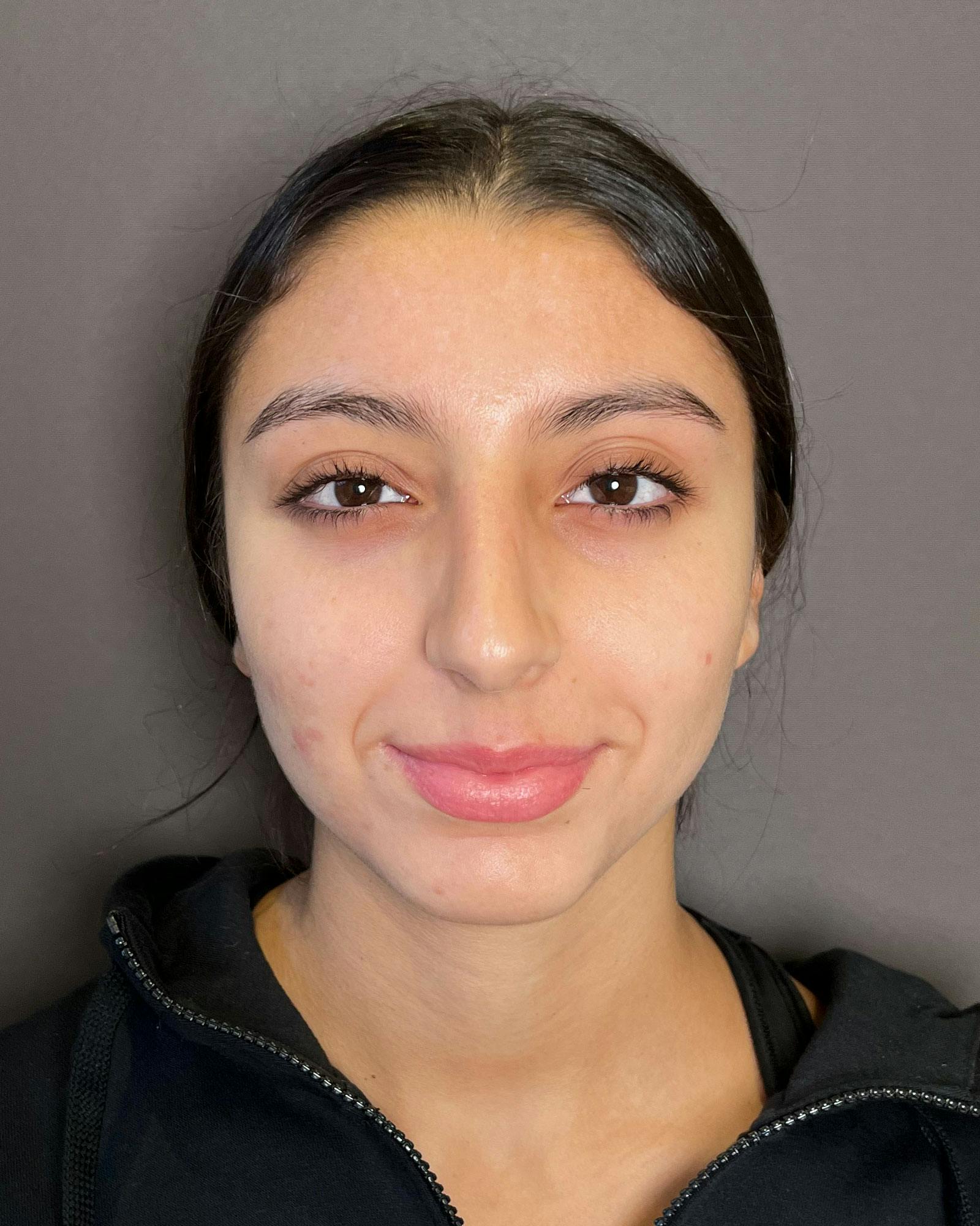 Rhinoplasty Before & After Gallery - Patient 183063820 - Image 5