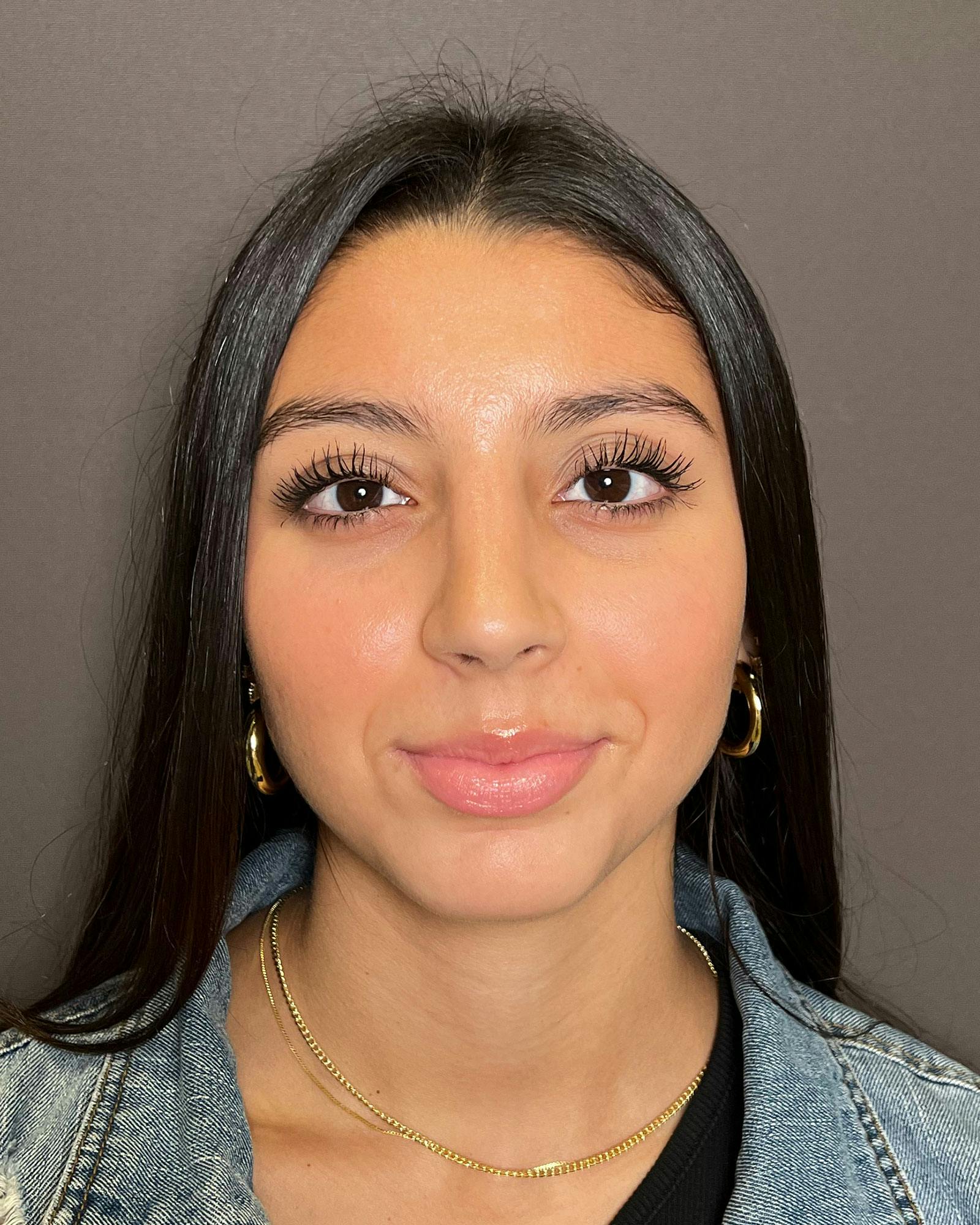 Rhinoplasty Before & After Gallery - Patient 183063820 - Image 6