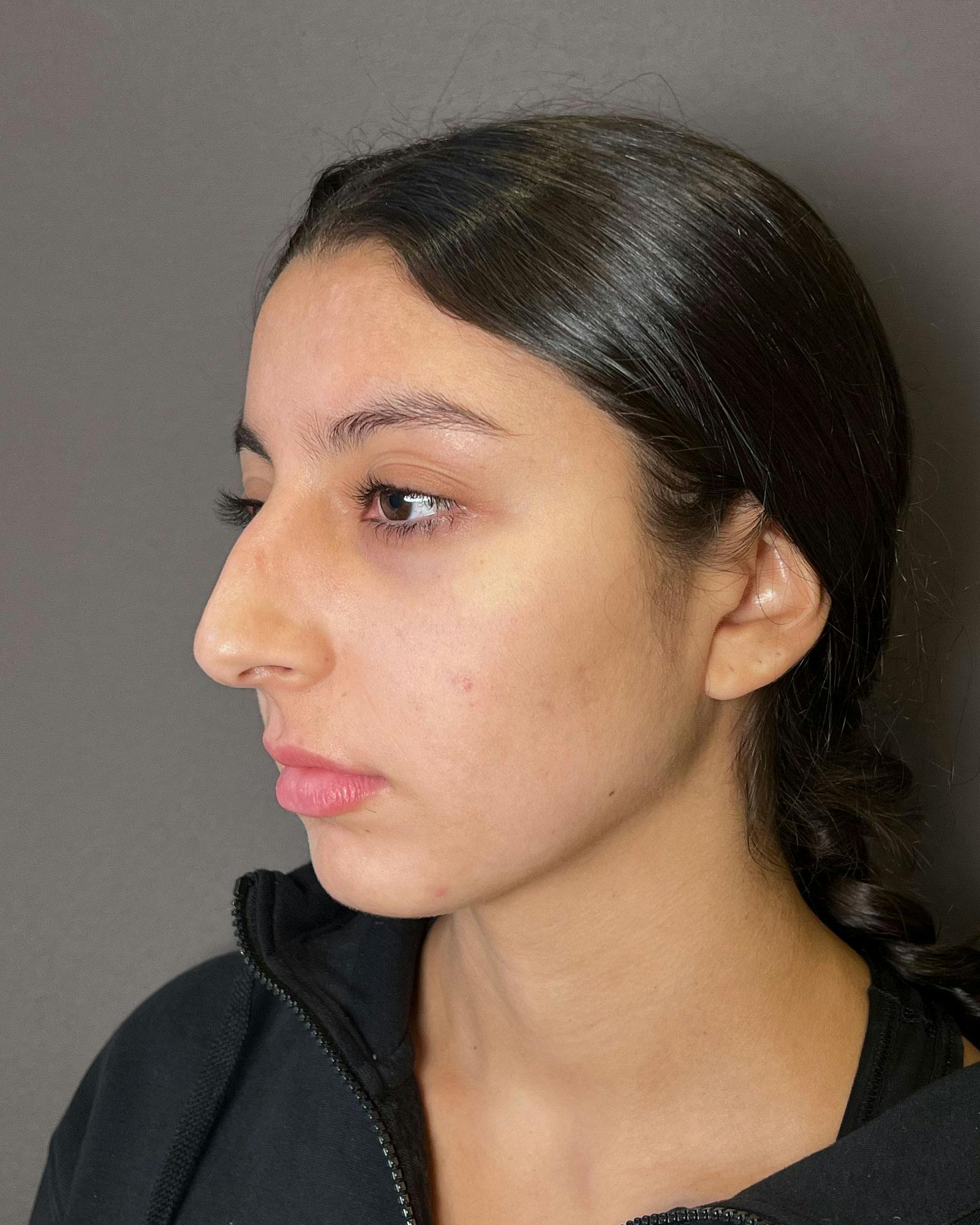 Rhinoplasty Before & After Gallery - Patient 183063820 - Image 7