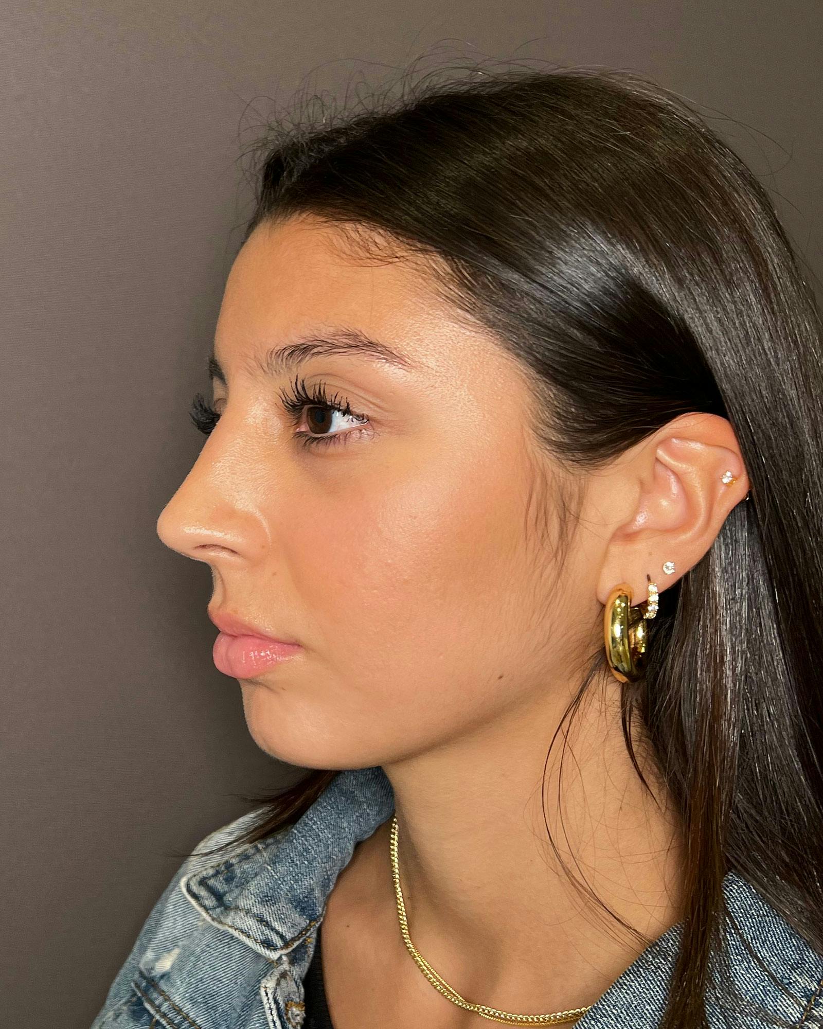 Rhinoplasty Before & After Gallery - Patient 183063820 - Image 8