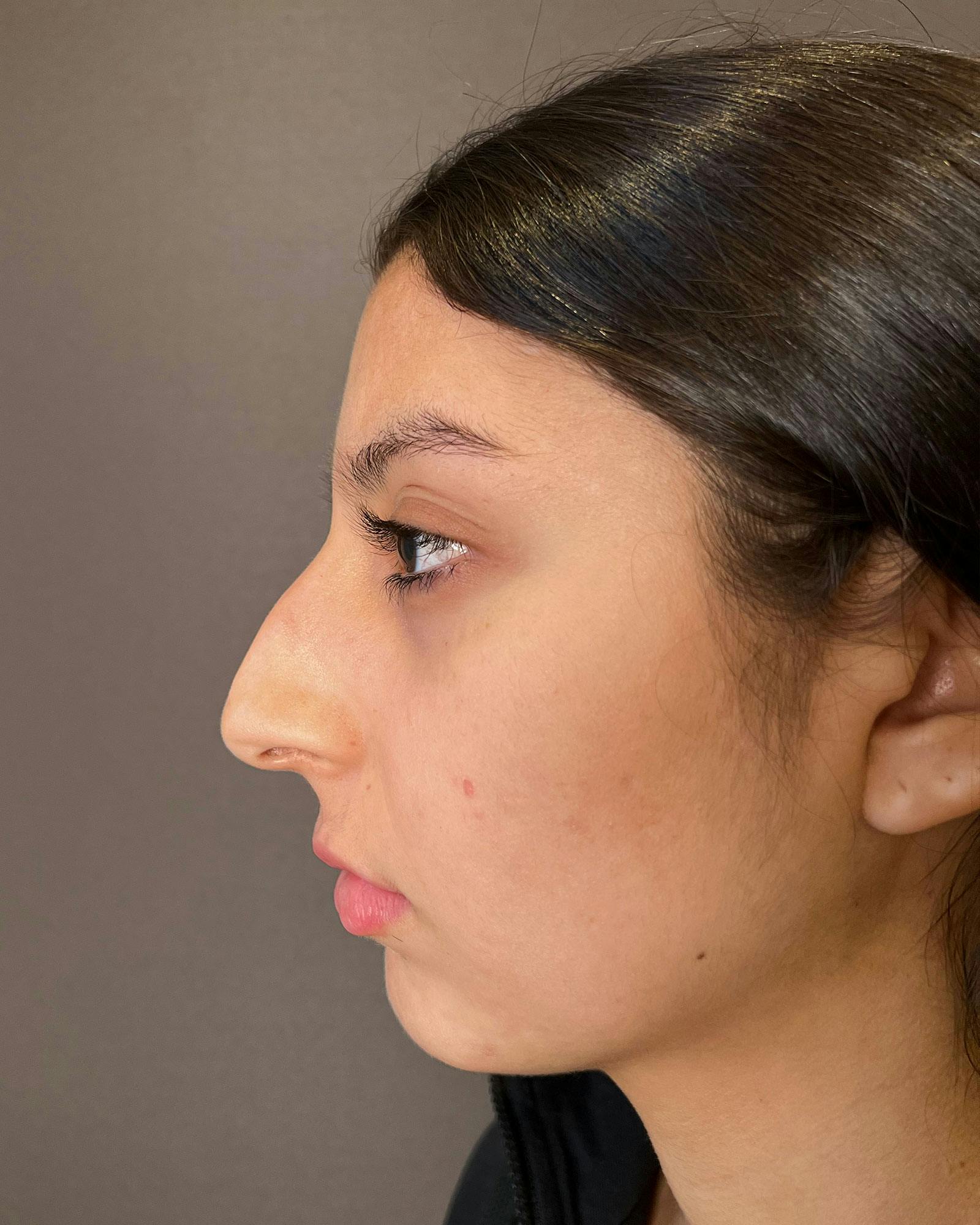 Rhinoplasty Before & After Gallery - Patient 183063820 - Image 9