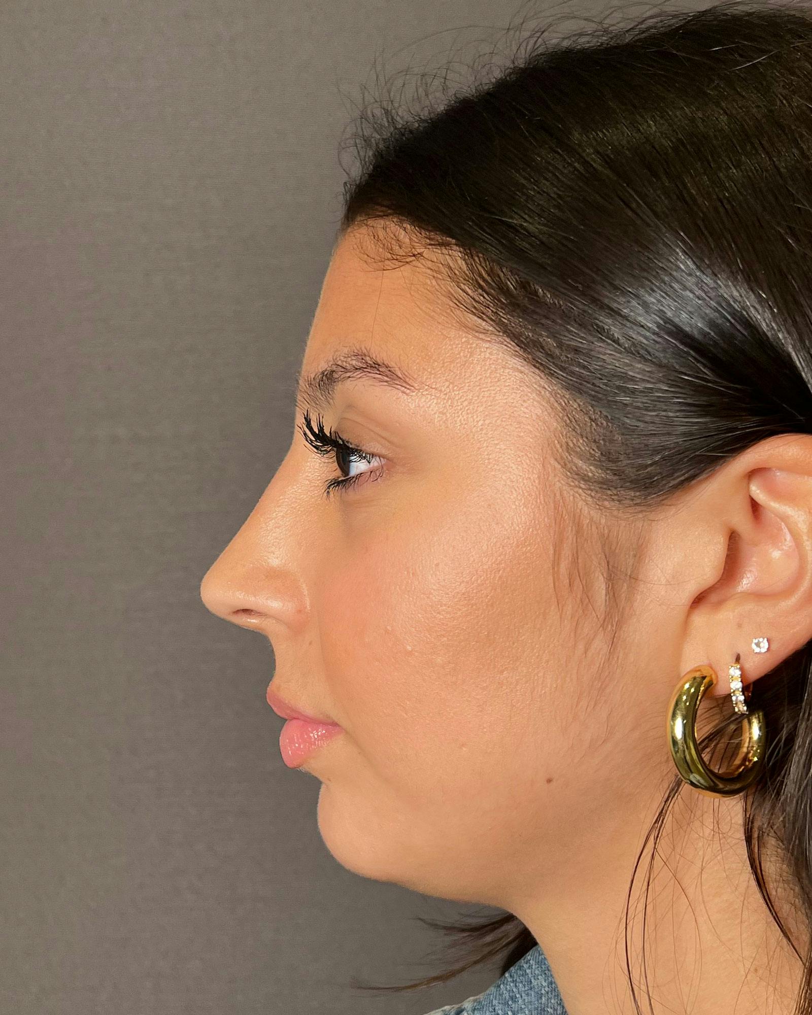 Rhinoplasty Before & After Gallery - Patient 183063820 - Image 10