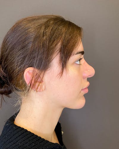 Rhinoplasty Before & After Gallery - Patient 183063821 - Image 1