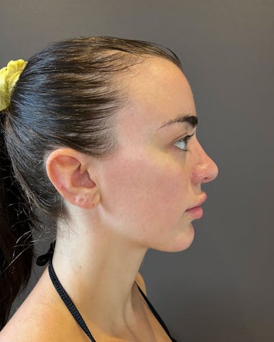 Rhinoplasty Before & After Gallery - Patient 183063821 - Image 2
