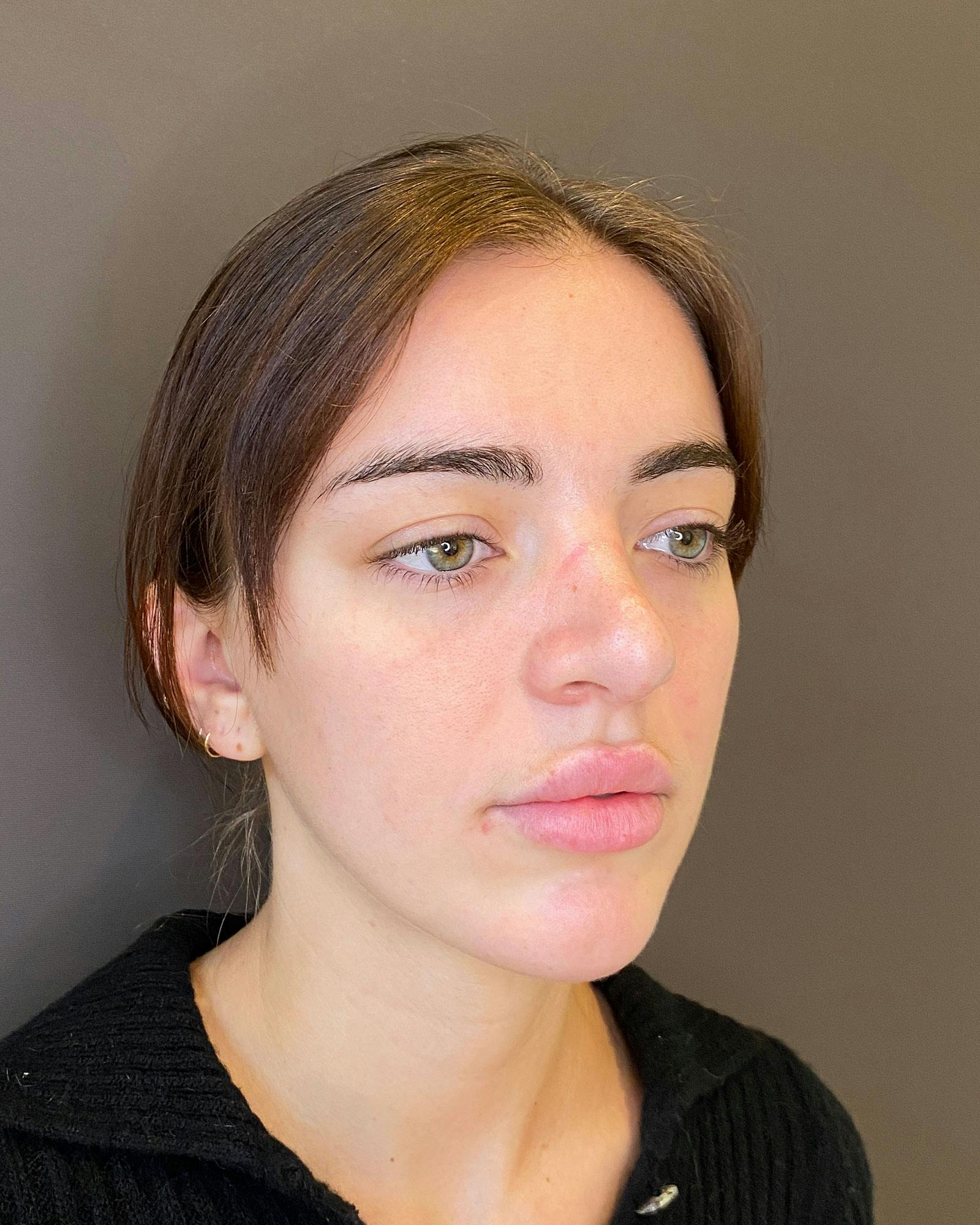 Rhinoplasty Before & After Gallery - Patient 183063821 - Image 3