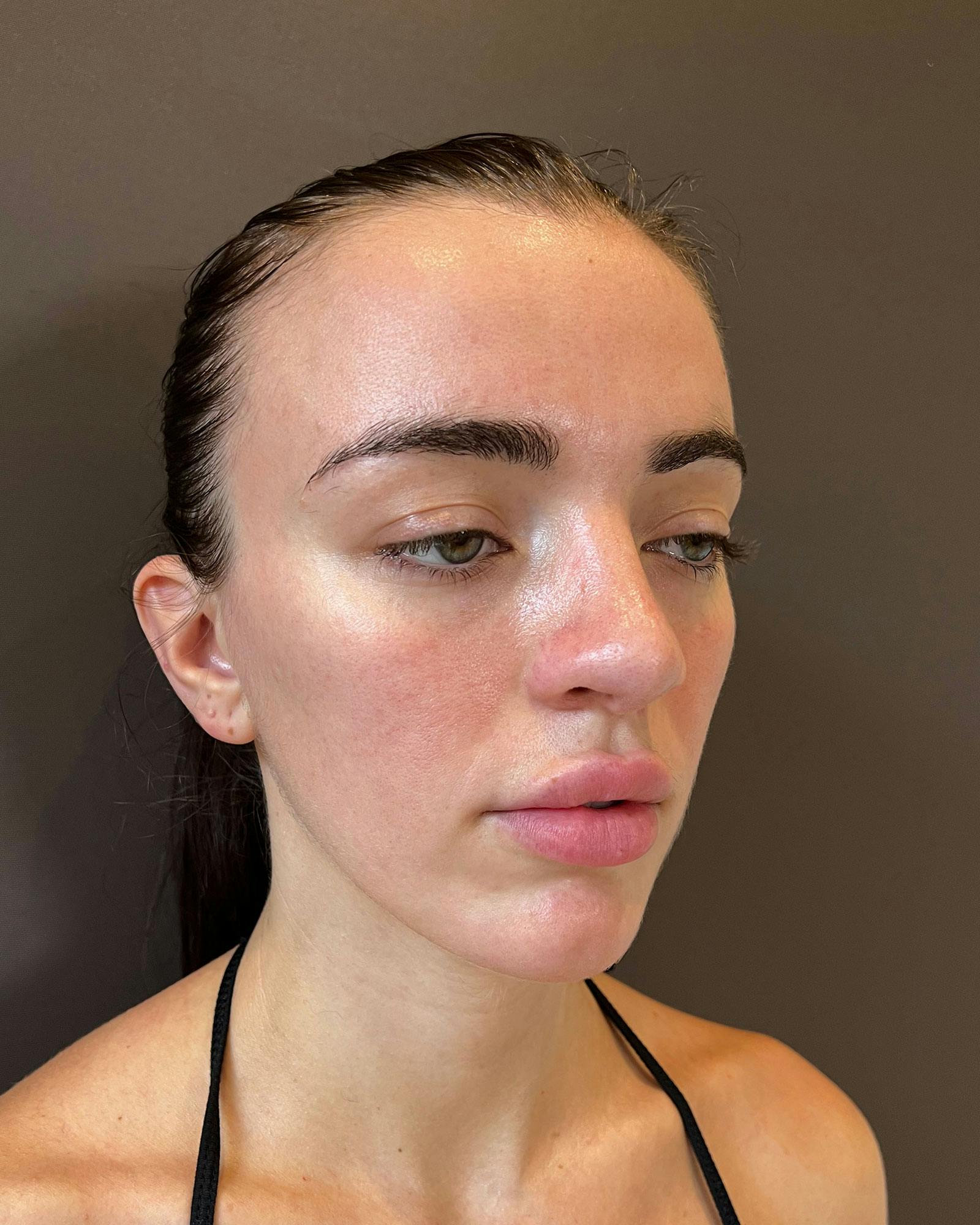 Rhinoplasty Before & After Gallery - Patient 183063821 - Image 4