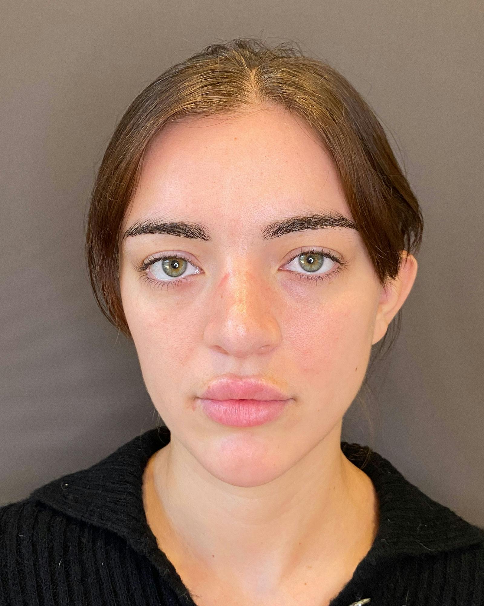 Rhinoplasty Before & After Gallery - Patient 183063821 - Image 5