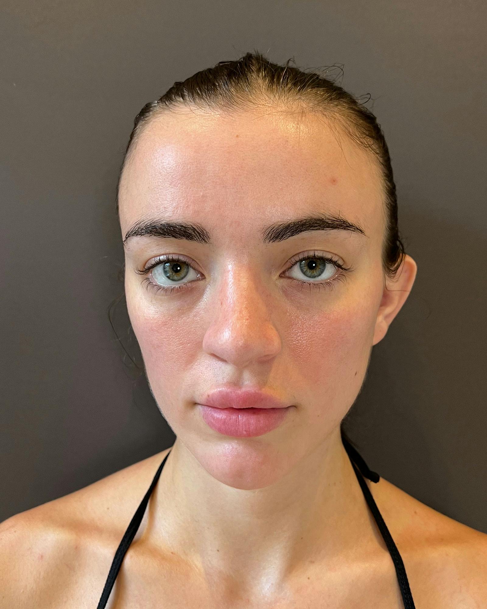 Rhinoplasty Before & After Gallery - Patient 183063821 - Image 6