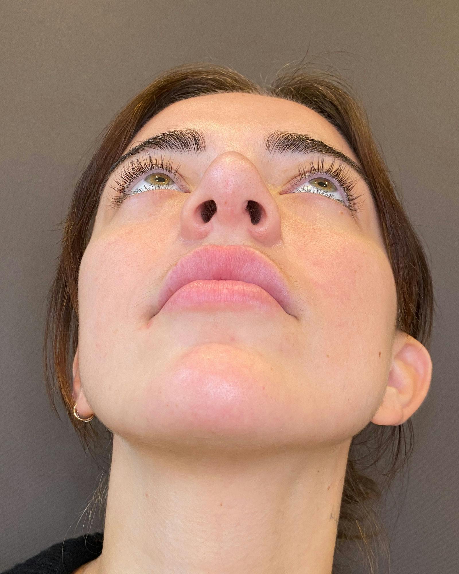 Rhinoplasty Before & After Gallery - Patient 183063821 - Image 7
