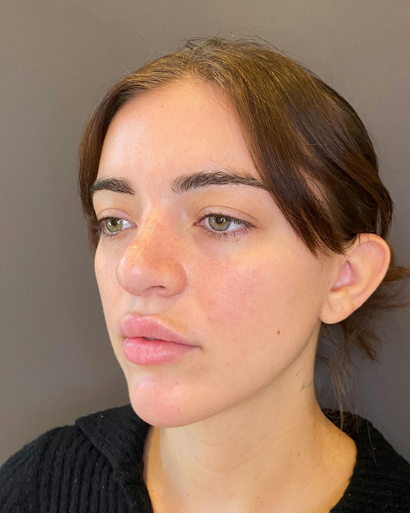 Rhinoplasty Before & After Gallery - Patient 183063821 - Image 9