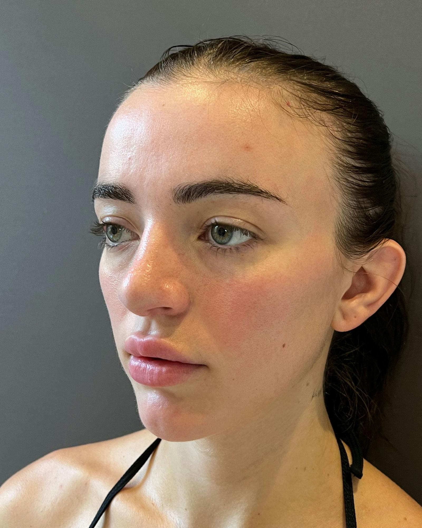 Rhinoplasty Before & After Gallery - Patient 183063821 - Image 10