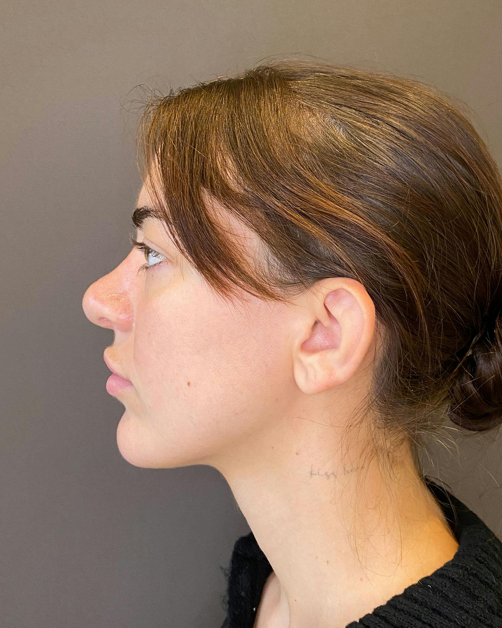 Rhinoplasty Before & After Gallery - Patient 183063821 - Image 11