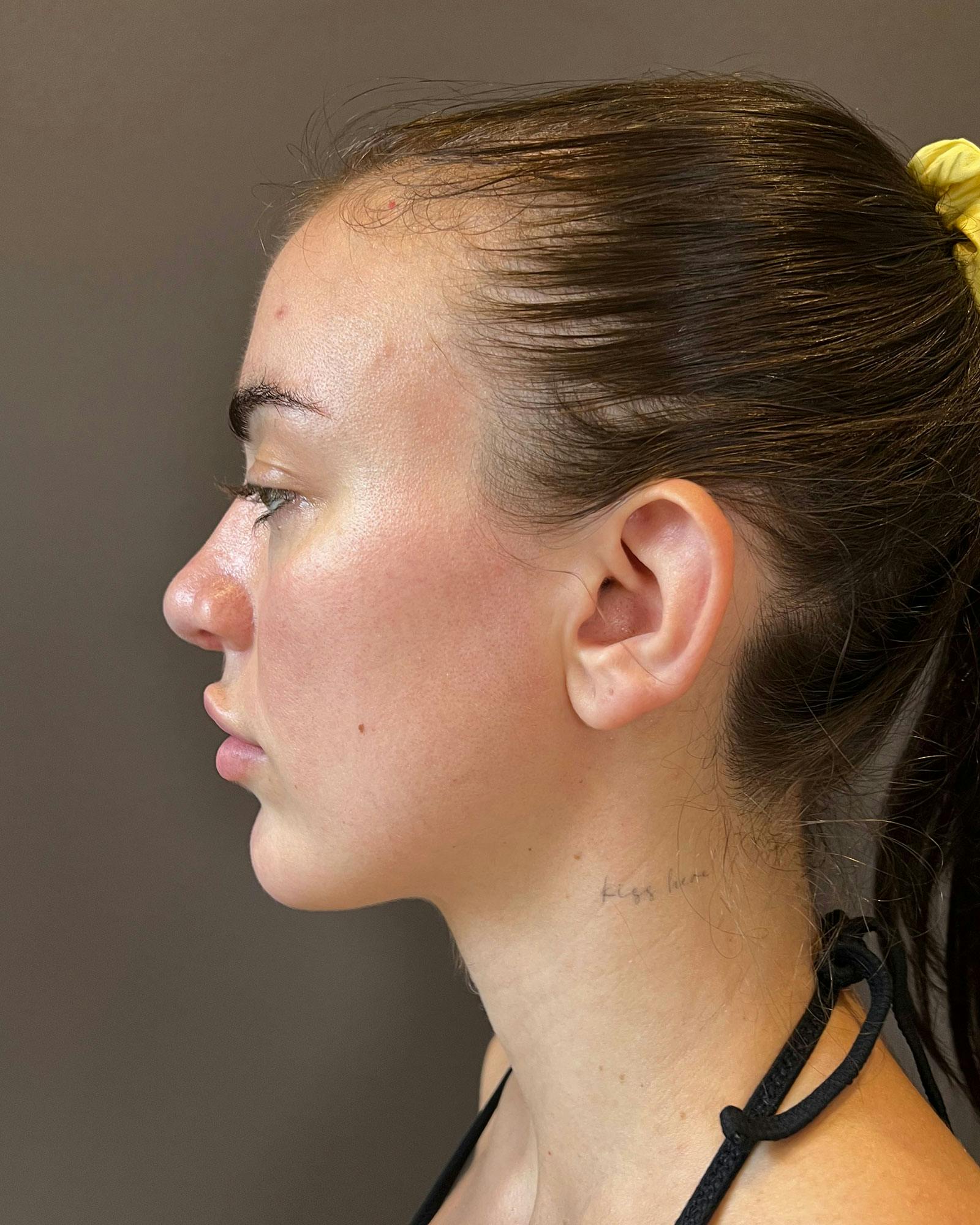 Rhinoplasty Before & After Gallery - Patient 183063821 - Image 12
