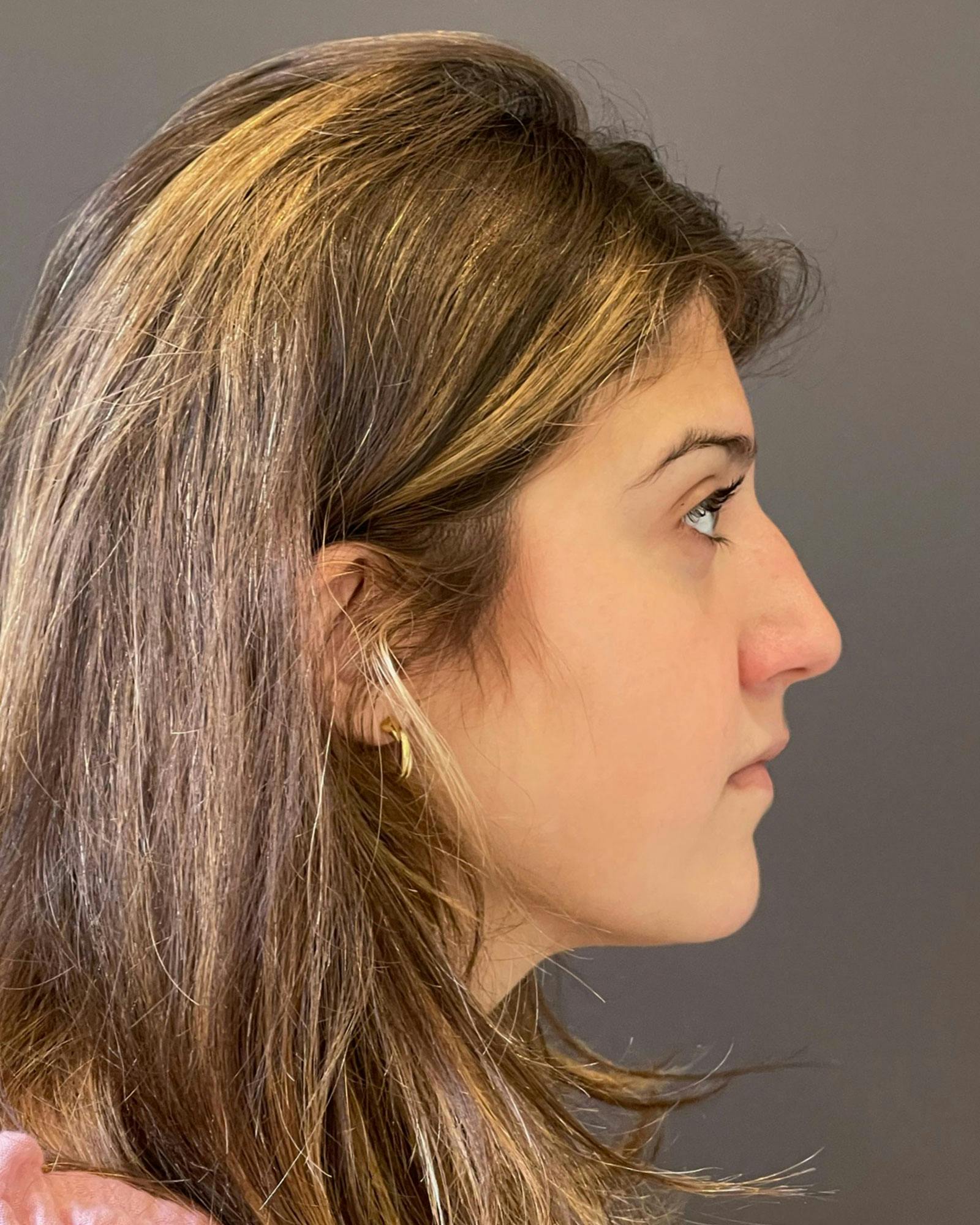 Rhinoplasty Before & After Gallery - Patient 183063822 - Image 1