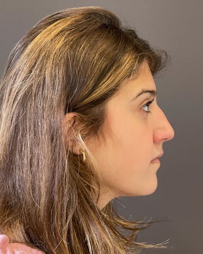 Rhinoplasty Before & After Gallery - Patient 183063822 - Image 1