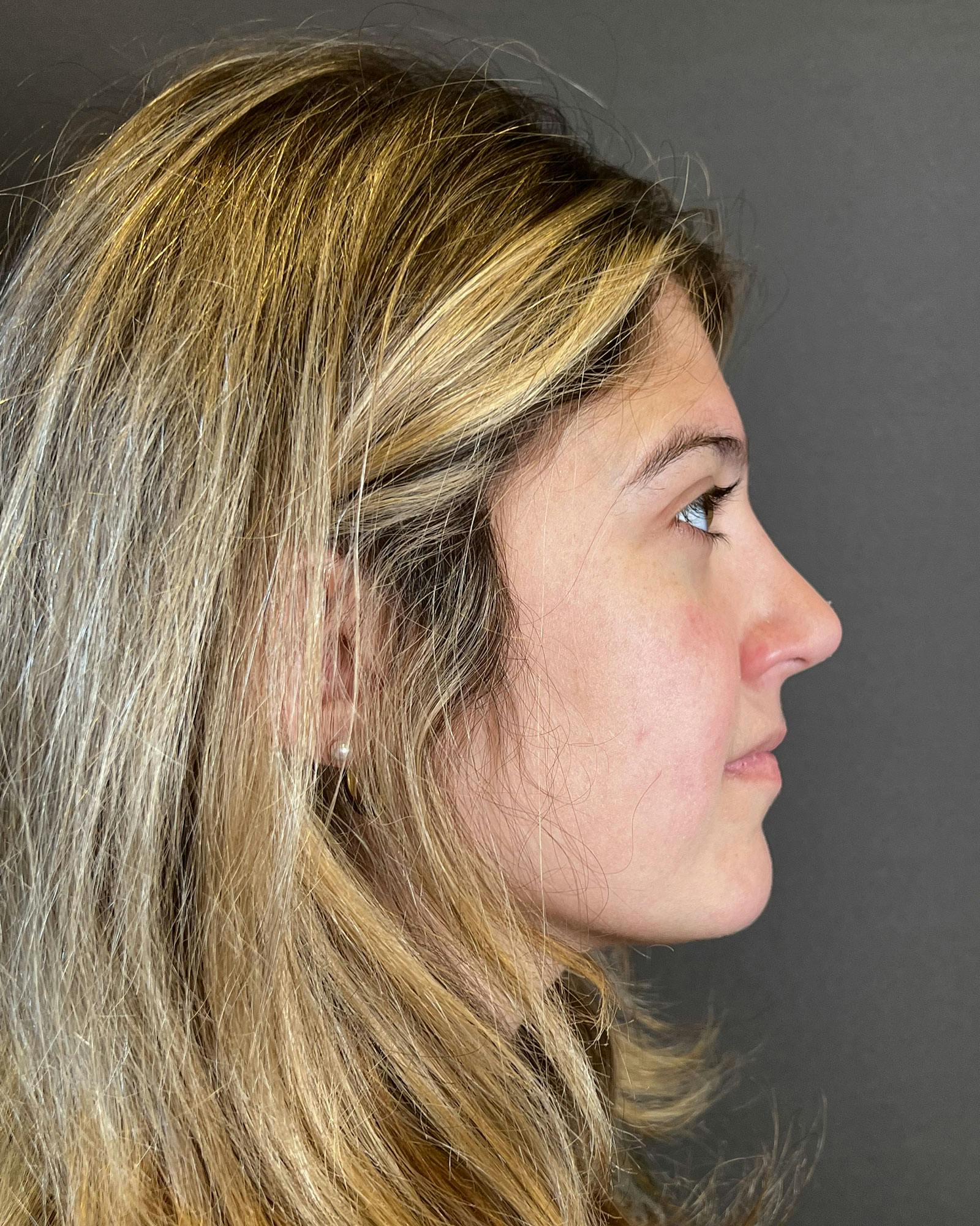 Rhinoplasty Before & After Gallery - Patient 183063822 - Image 2