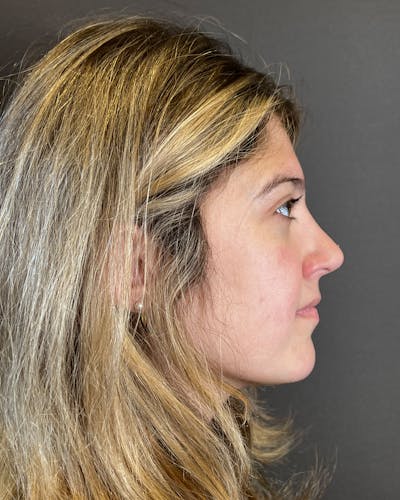 Rhinoplasty Before & After Gallery - Patient 183063822 - Image 2