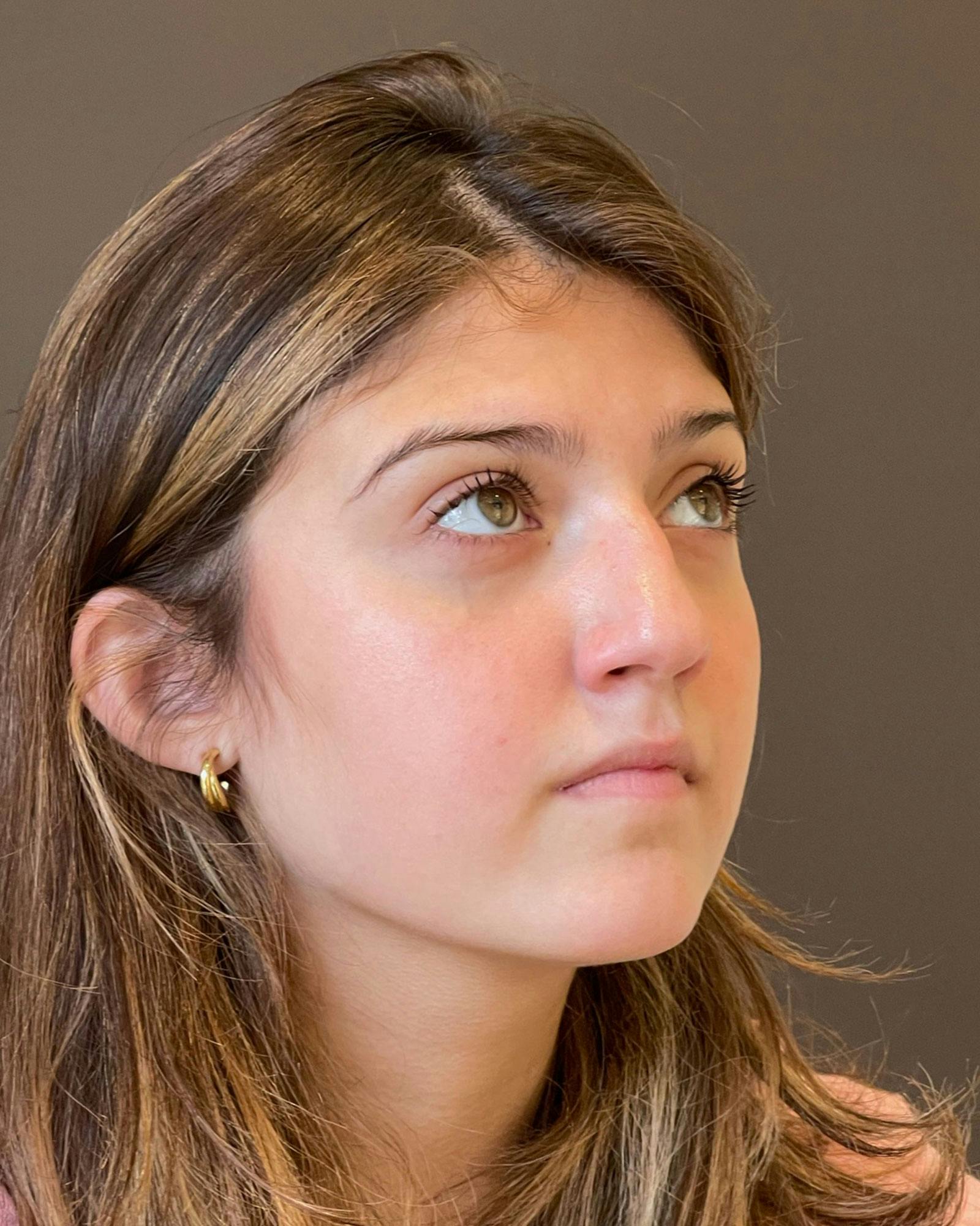 Rhinoplasty Before & After Gallery - Patient 183063822 - Image 3
