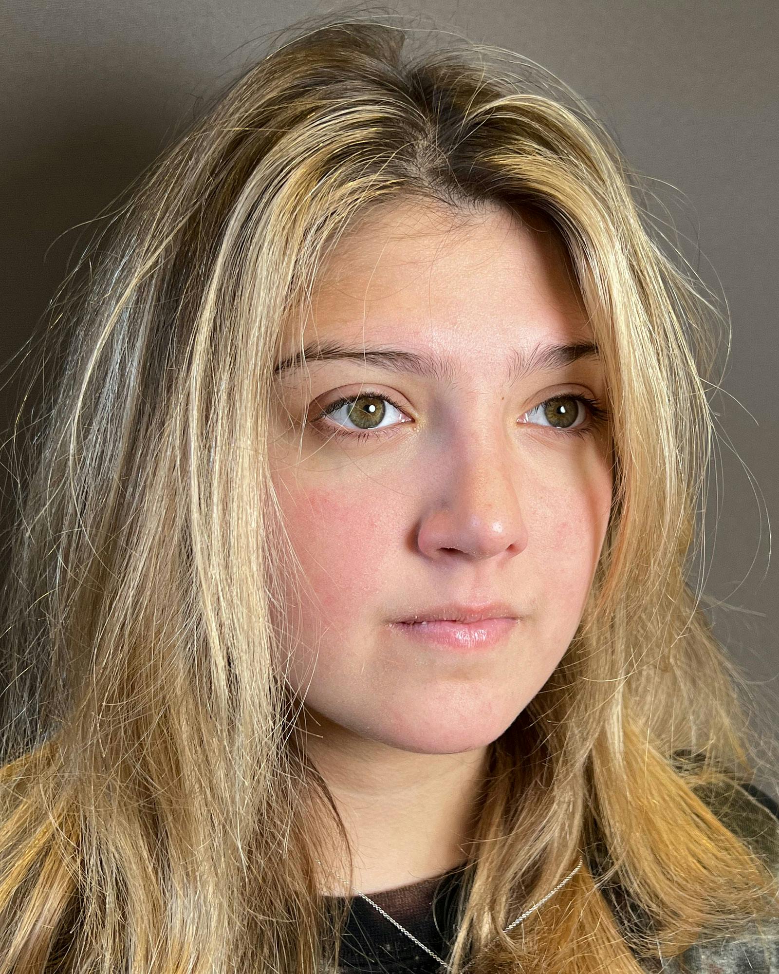 Rhinoplasty Before & After Gallery - Patient 183063822 - Image 4