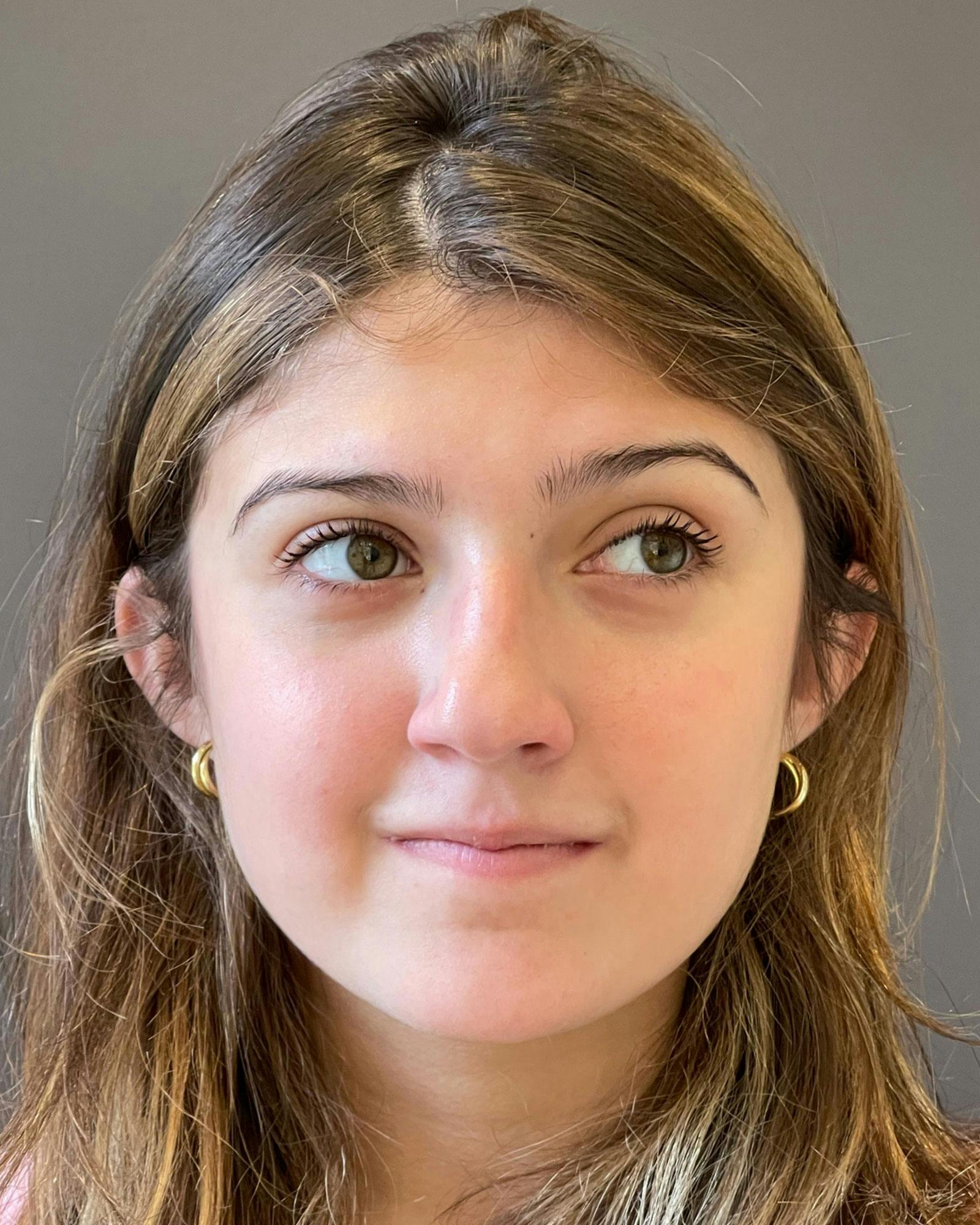 Rhinoplasty Before & After Gallery - Patient 183063822 - Image 5