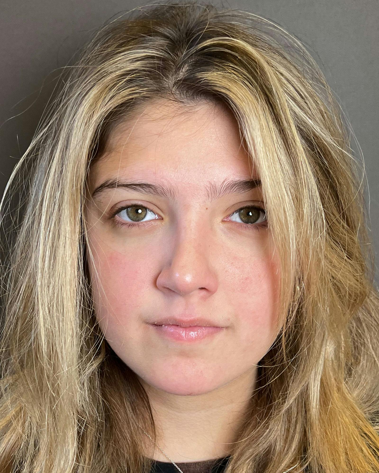Rhinoplasty Before & After Gallery - Patient 183063822 - Image 6