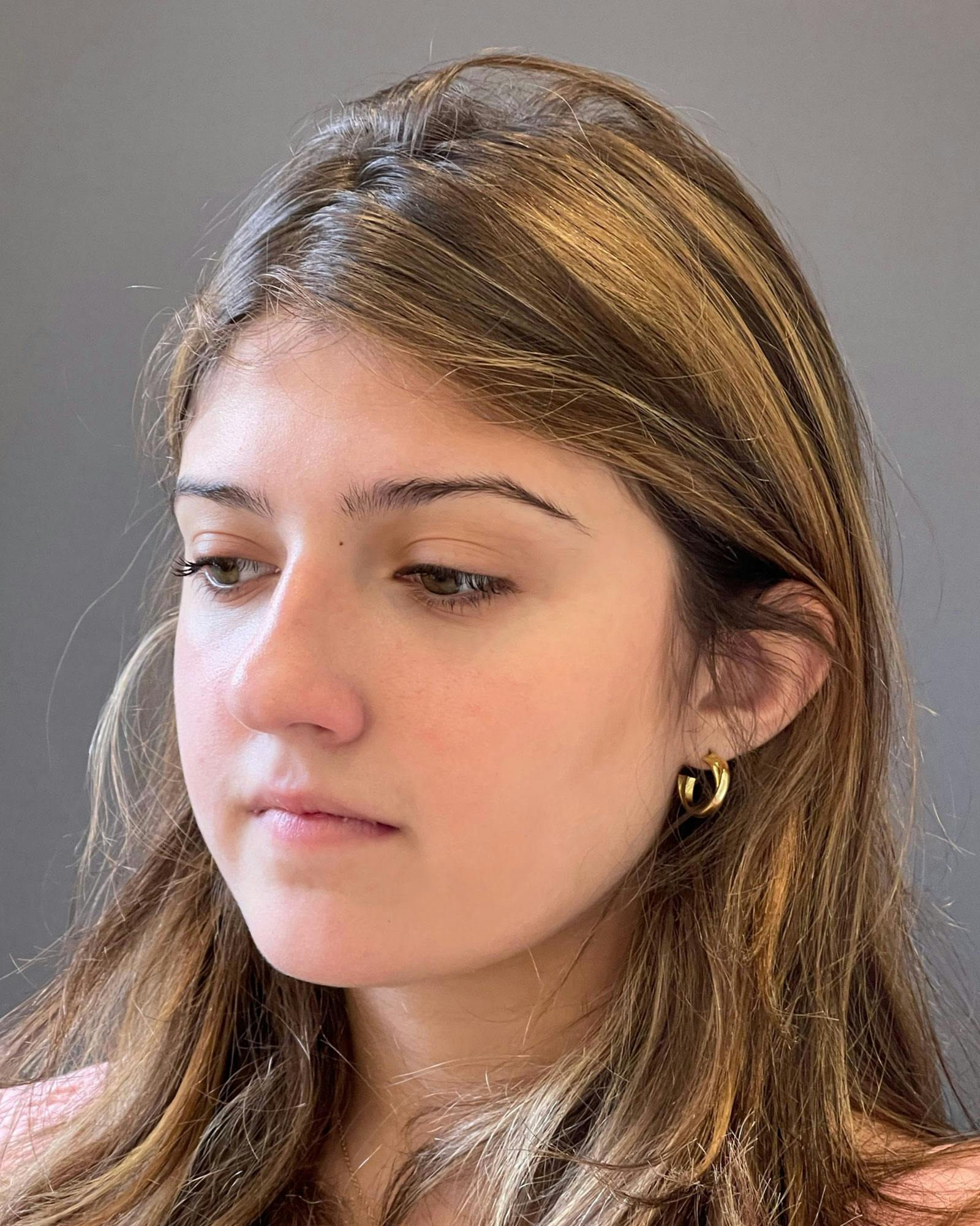 Rhinoplasty Before & After Gallery - Patient 183063822 - Image 7