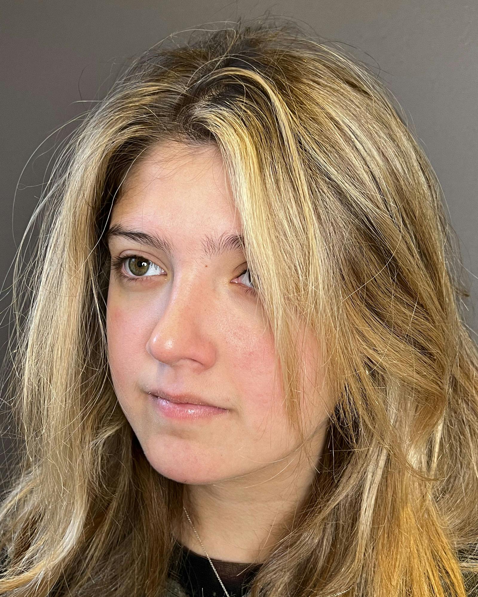 Rhinoplasty Before & After Gallery - Patient 183063822 - Image 8