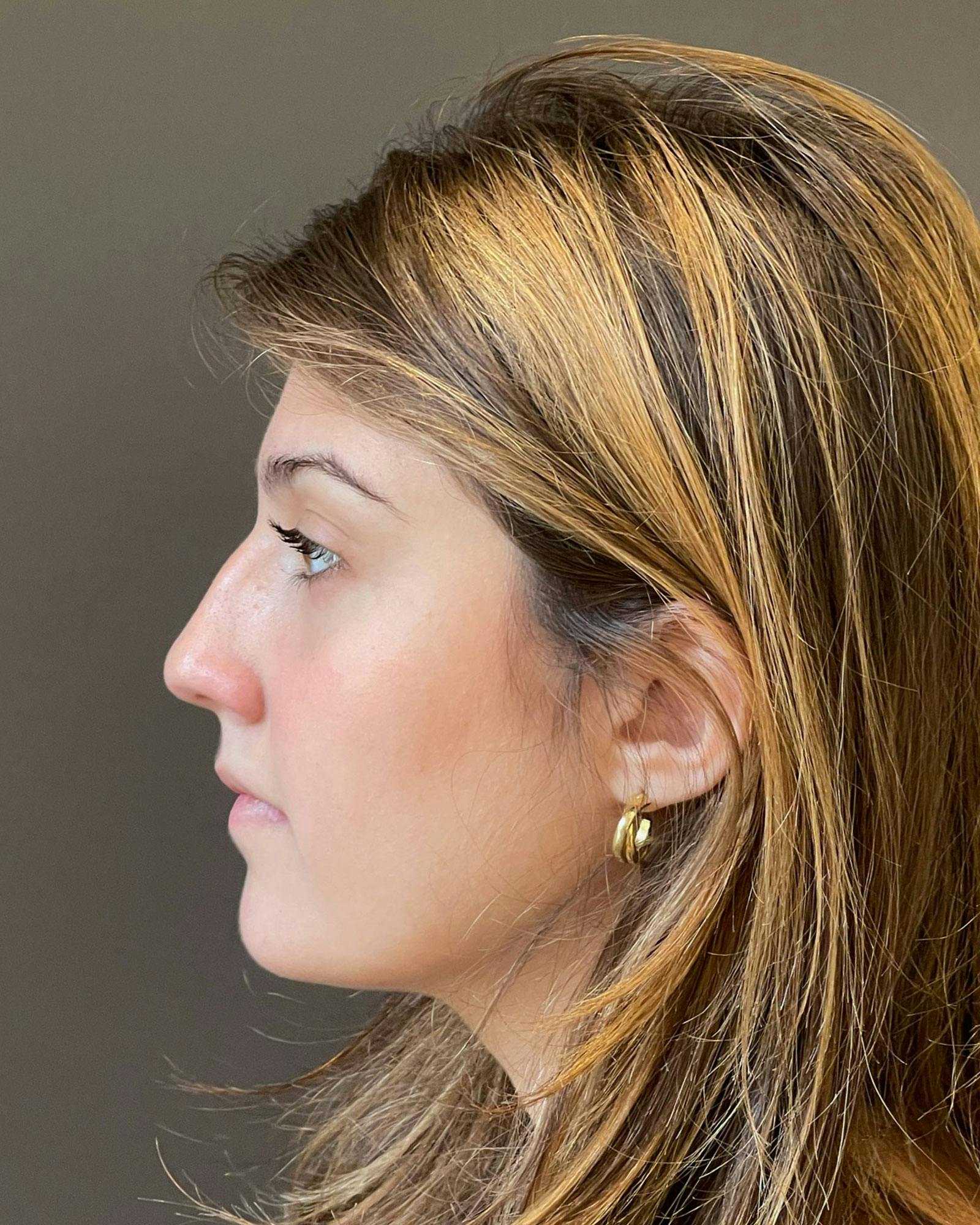 Rhinoplasty Before & After Gallery - Patient 183063822 - Image 9
