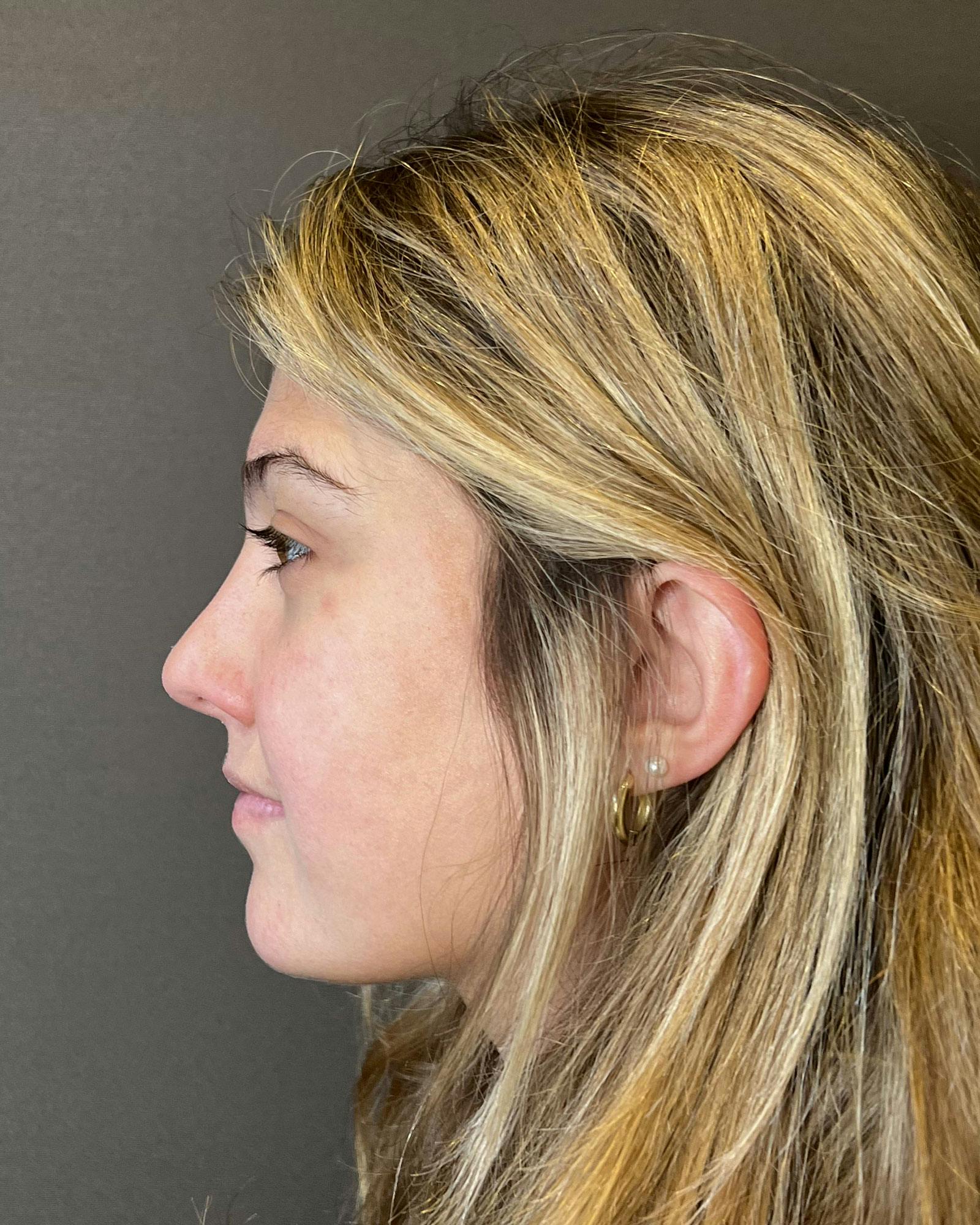 Rhinoplasty Before & After Gallery - Patient 183063822 - Image 10
