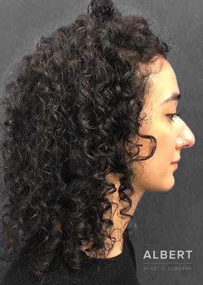 Rhinoplasty Before & After Gallery - Patient 151510786 - Image 1