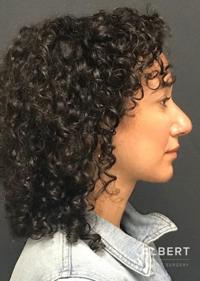 Rhinoplasty Before & After Gallery - Patient 151510786 - Image 2