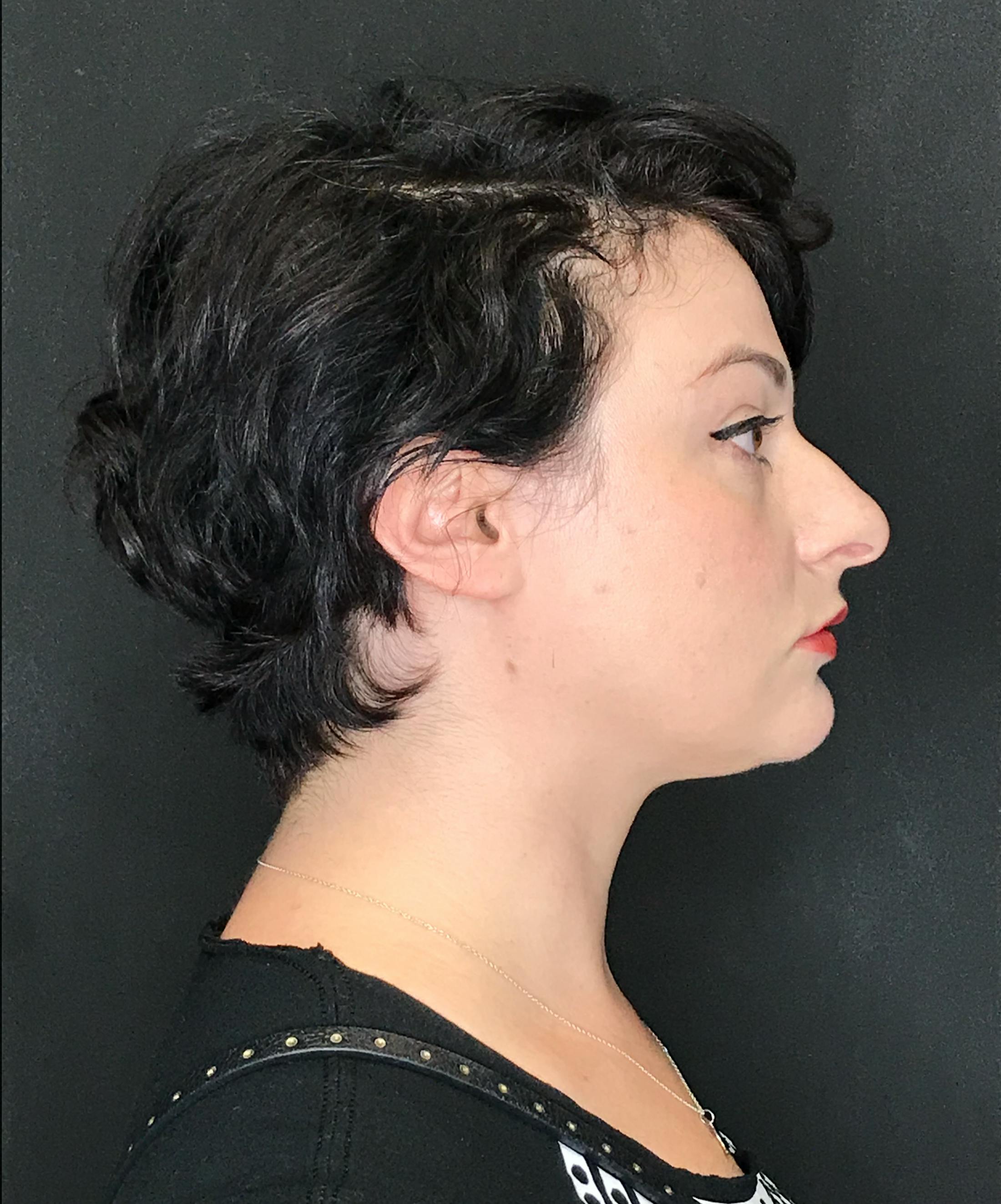 Rhinoplasty Before & After Gallery - Patient 151521036 - Image 1
