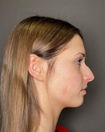 Rhinoplasty Before & After Gallery - Patient 191294098 - Image 1